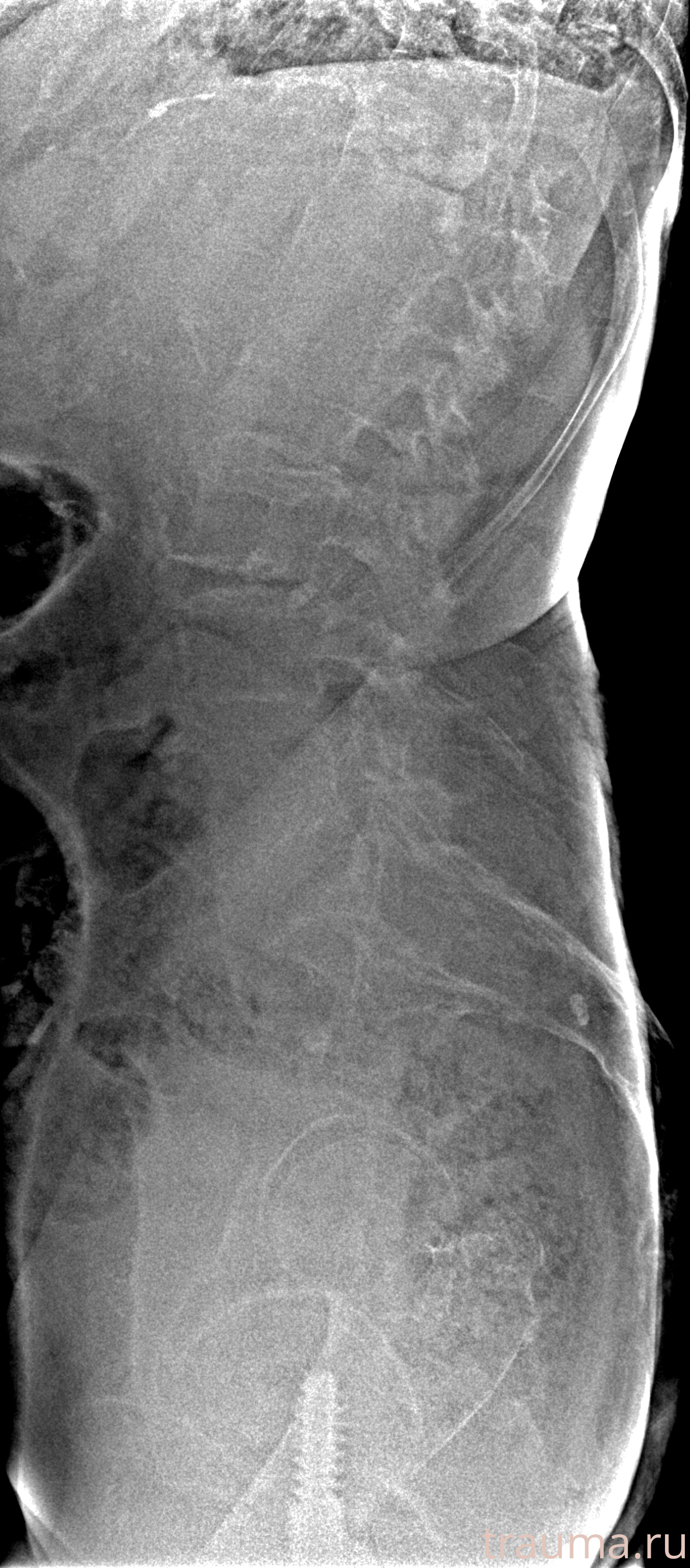 Рентген на дому: по вашему адресу приезжает врач-рентгенолог, травматолог-ортопед с мобильным рентгеновским аппаратом, проводит диагностику травмы или заболевания, делает необходимые рентгенограммы, дает рекомендации по дальнейшему лечению. Получить качественные снимки в домашних условиях возможно благодаря уникальной методике, разработанной МосРентген Центром для института  Склифосовского