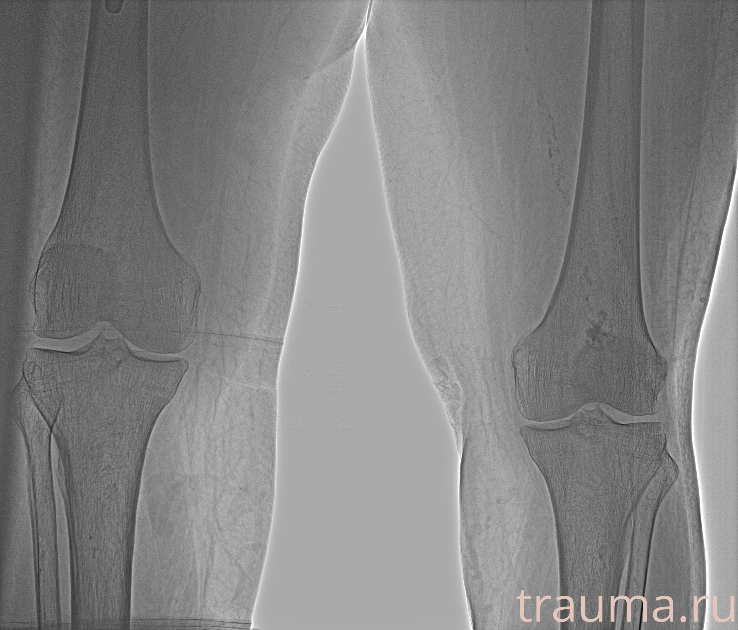 Рентген на дому: по вашему адресу приезжает врач-рентгенолог, травматолог-ортопед с мобильным рентгеновским аппаратом, проводит диагностику травмы или заболевания, делает необходимые рентгенограммы, дает рекомендации по дальнейшему лечению. Получить качественные снимки в домашних условиях возможно благодаря уникальной методике, разработанной МосРентген Центром для института  Склифосовского