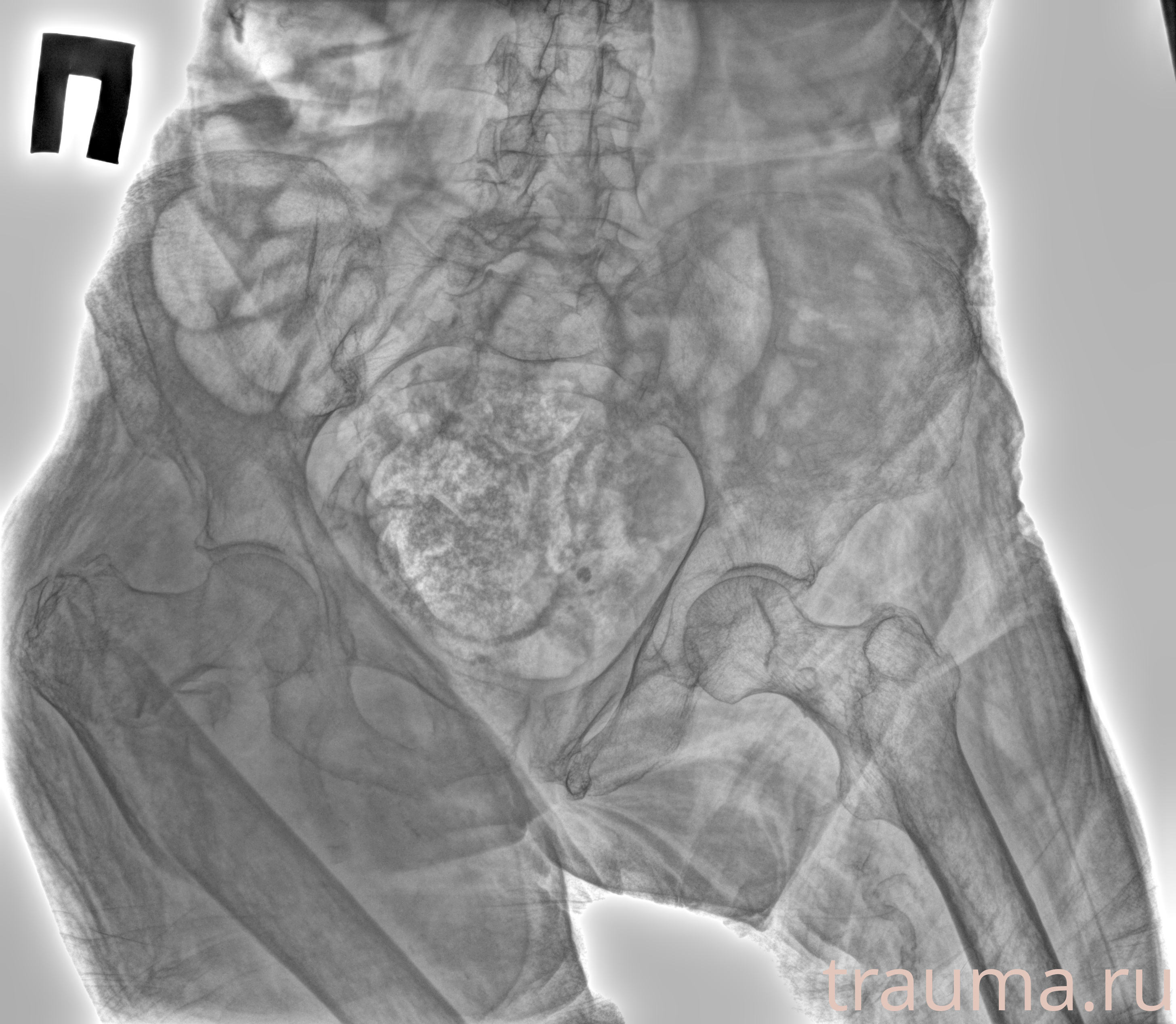 Рентген на дому: по вашему адресу приезжает врач-рентгенолог, травматолог-ортопед с мобильным рентгеновским аппаратом, проводит диагностику травмы или заболевания, делает необходимые рентгенограммы, дает рекомендации по дальнейшему лечению. Получить качественные снимки в домашних условиях возможно благодаря уникальной методике, разработанной МосРентген Центром для института  Склифосовского