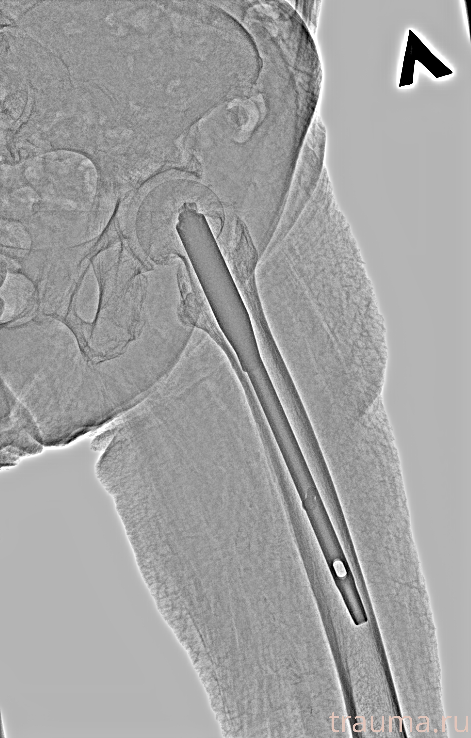 Рентген на дому: по вашему адресу приезжает врач-рентгенолог, травматолог-ортопед с мобильным рентгеновским аппаратом, проводит диагностику травмы или заболевания, делает необходимые рентгенограммы, дает рекомендации по дальнейшему лечению. Получить качественные снимки в домашних условиях возможно благодаря уникальной методике, разработанной МосРентген Центром для института  Склифосовского