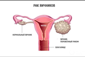 Рак яичников / рак маточной трубы / первичный рак брюшины Рак яичников / рак маточной трубы / первичный рак брюшины