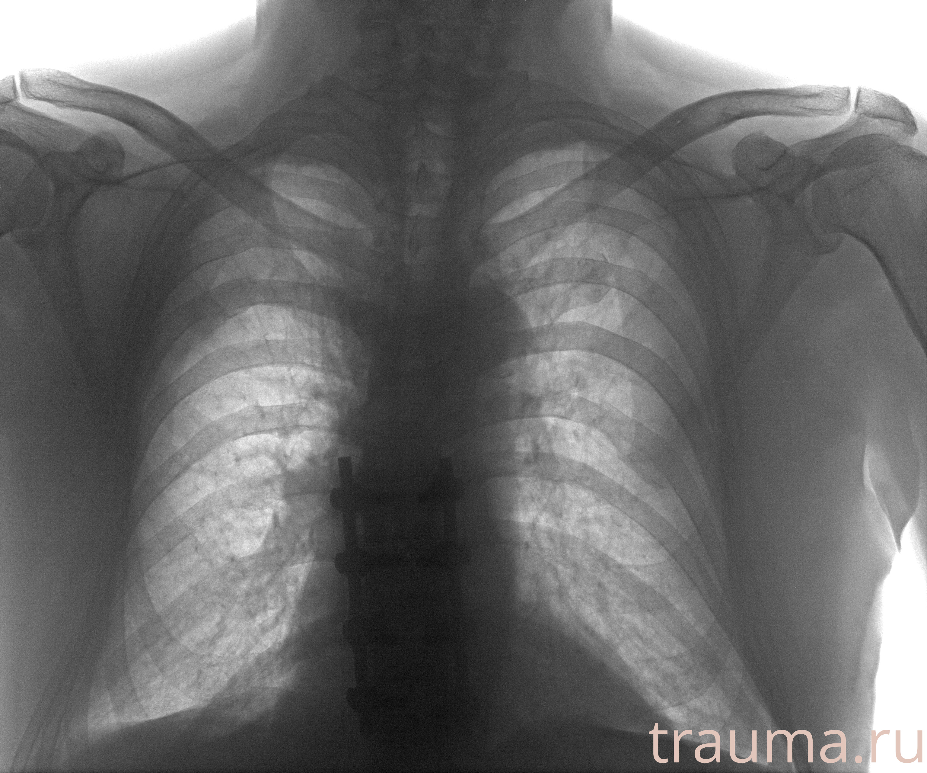 Рентген на дому: по вашему адресу приезжает врач-рентгенолог, травматолог-ортопед с мобильным рентгеновским аппаратом, проводит диагностику травмы или заболевания, делает необходимые рентгенограммы, дает рекомендации по дальнейшему лечению. Получить качественные снимки в домашних условиях возможно благодаря уникальной методике, разработанной МосРентген Центром для института  Склифосовского