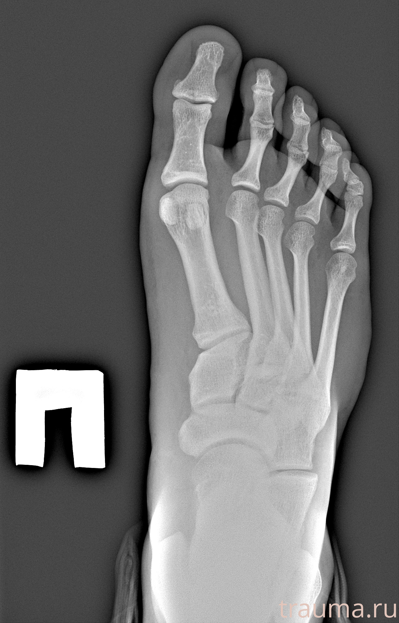 Рентген на дому: по вашему адресу приезжает врач-рентгенолог, травматолог-ортопед с мобильным рентгеновским аппаратом, проводит диагностику травмы или заболевания, делает необходимые рентгенограммы, дает рекомендации по дальнейшему лечению. Получить качественные снимки в домашних условиях возможно благодаря уникальной методике, разработанной МосРентген Центром для института  Склифосовского