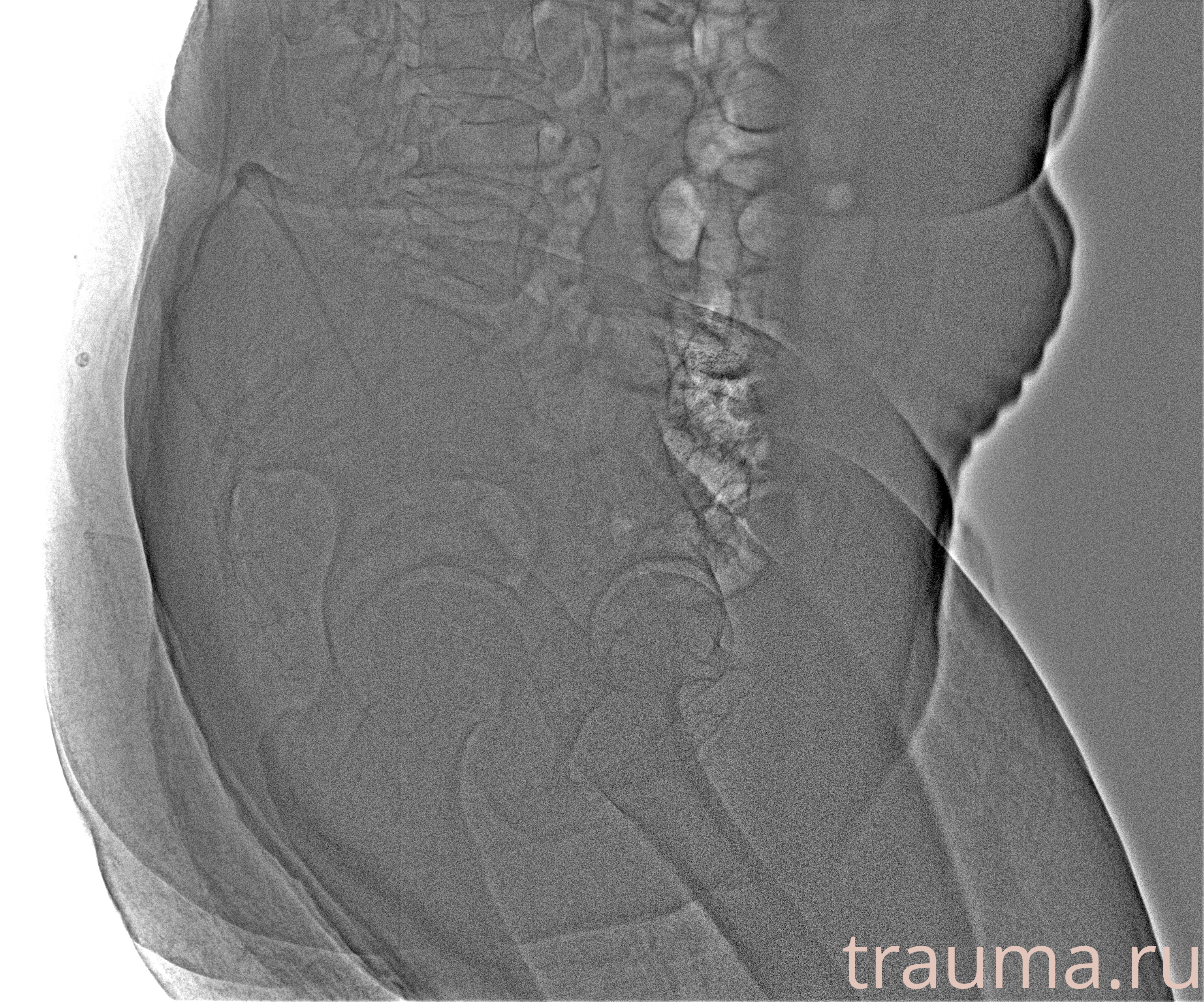 Рентген на дому: по вашему адресу приезжает врач-рентгенолог, травматолог-ортопед с мобильным рентгеновским аппаратом, проводит диагностику травмы или заболевания, делает необходимые рентгенограммы, дает рекомендации по дальнейшему лечению. Получить качественные снимки в домашних условиях возможно благодаря уникальной методике, разработанной МосРентген Центром для института  Склифосовского