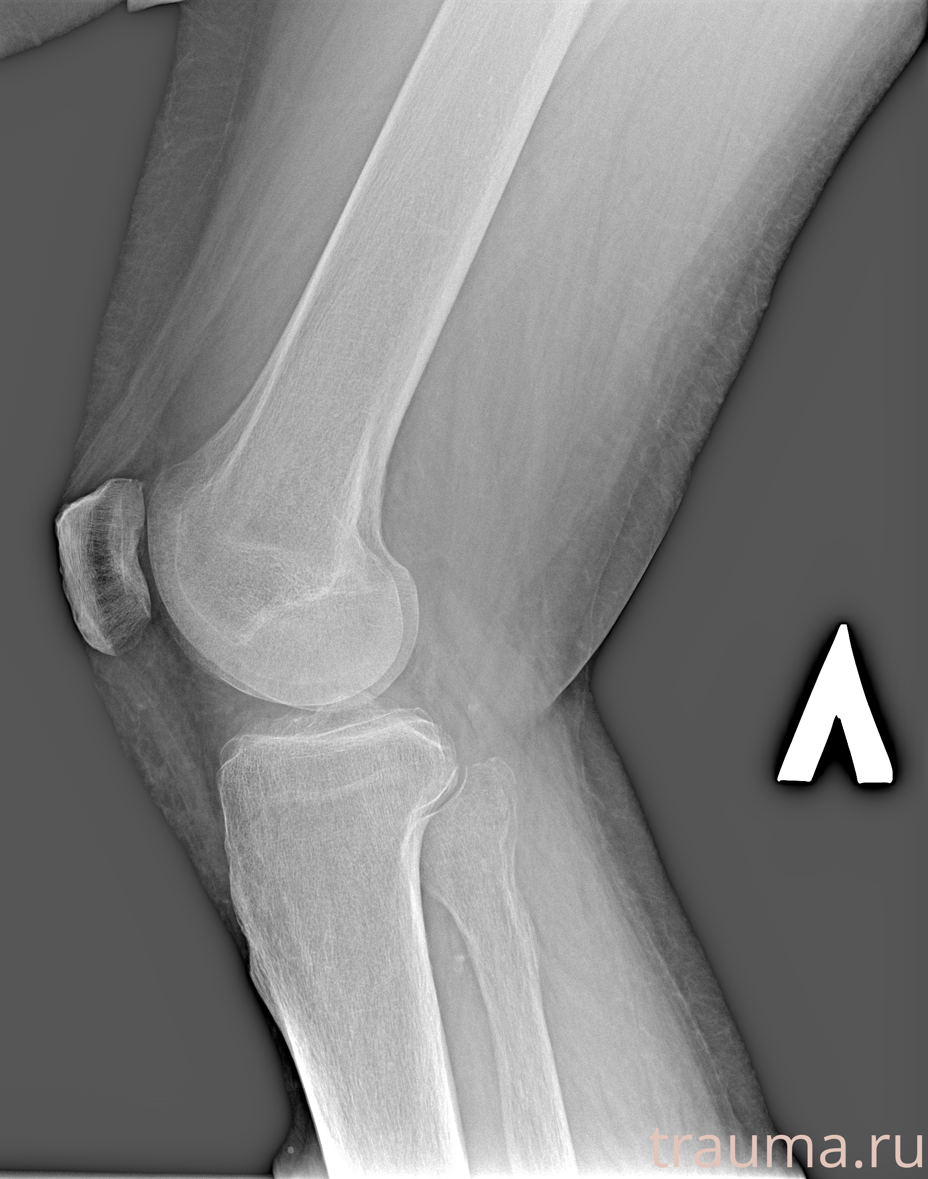 Рентген на дому: по вашему адресу приезжает врач-рентгенолог, травматолог-ортопед с мобильным рентгеновским аппаратом, проводит диагностику травмы или заболевания, делает необходимые рентгенограммы, дает рекомендации по дальнейшему лечению. Получить качественные снимки в домашних условиях возможно благодаря уникальной методике, разработанной МосРентген Центром для института  Склифосовского
