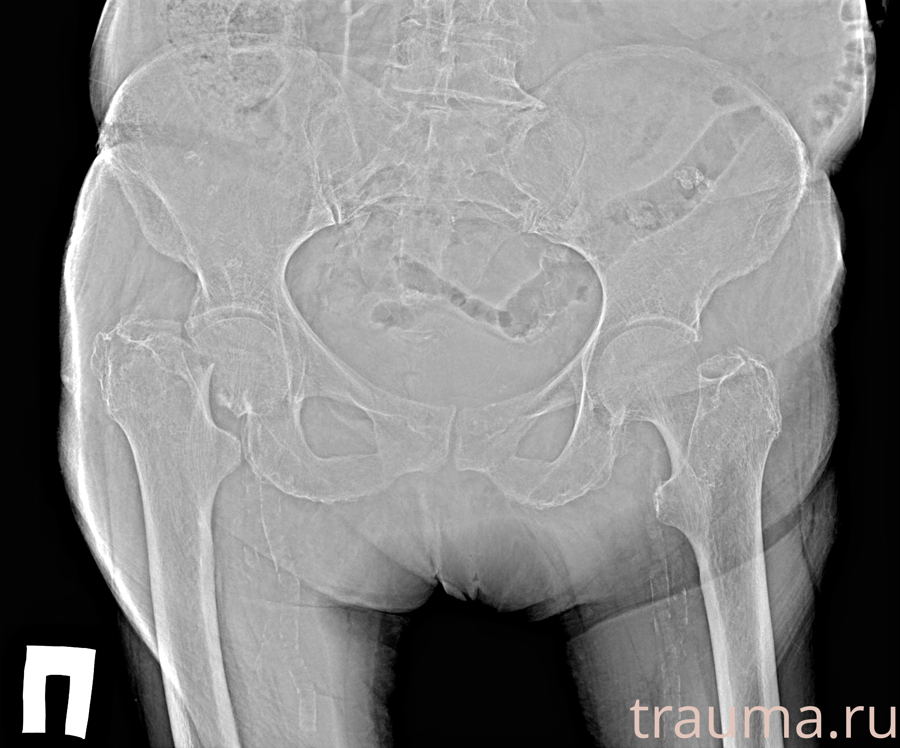 Рентген на дому: по вашему адресу приезжает врач-рентгенолог, травматолог-ортопед с мобильным рентгеновским аппаратом, проводит диагностику травмы или заболевания, делает необходимые рентгенограммы, дает рекомендации по дальнейшему лечению. Получить качественные снимки в домашних условиях возможно благодаря уникальной методике, разработанной МосРентген Центром для института  Склифосовского