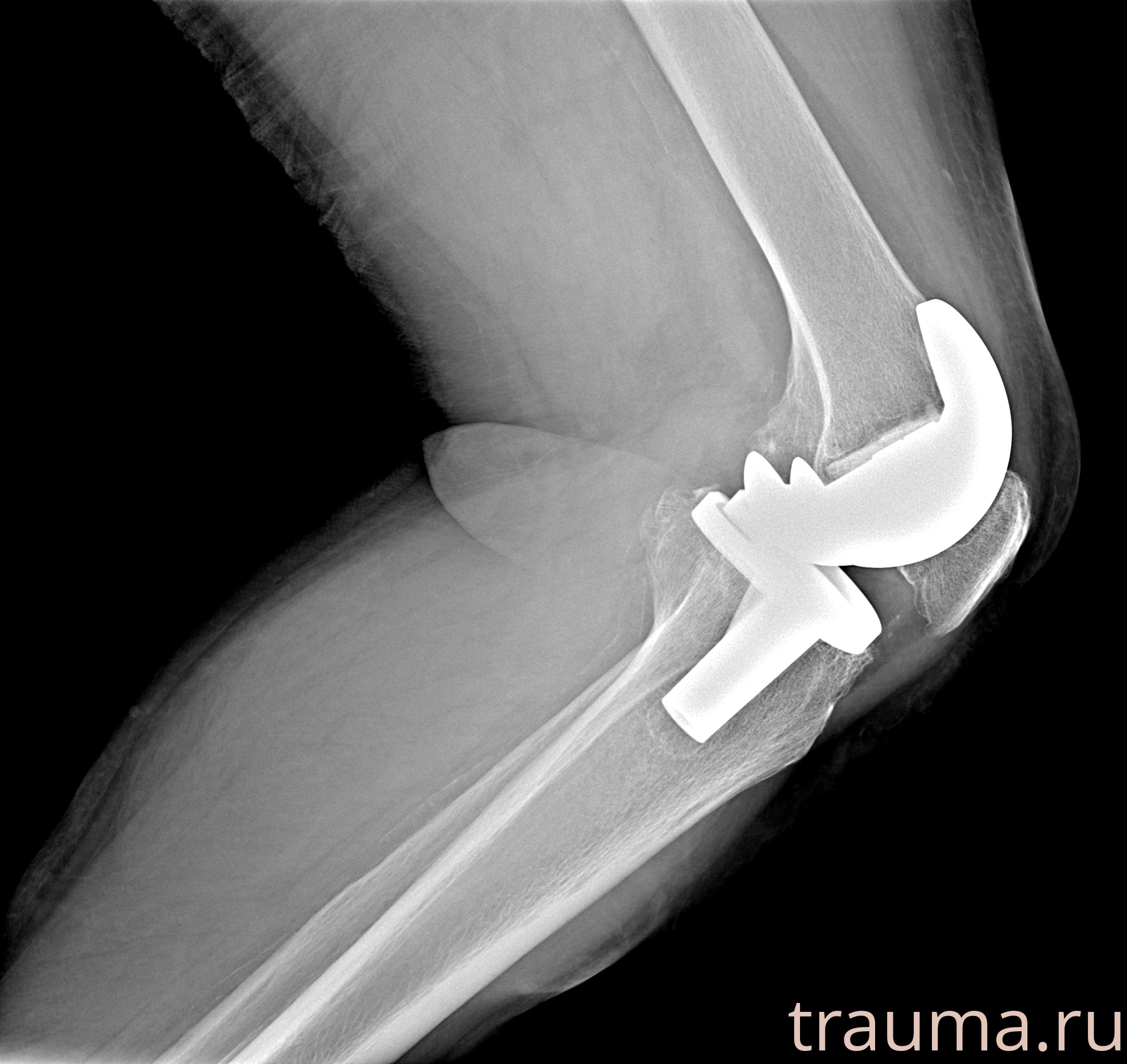 Рентген на дому: по вашему адресу приезжает врач-рентгенолог, травматолог-ортопед с мобильным рентгеновским аппаратом, проводит диагностику травмы или заболевания, делает необходимые рентгенограммы, дает рекомендации по дальнейшему лечению. Получить качественные снимки в домашних условиях возможно благодаря уникальной методике, разработанной МосРентген Центром для института  Склифосовского