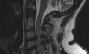 Возможности оценки состояния паравертебральных мышц по данным МРТ перед операцией по поводу стеноза позвоночного канала
 Возможности оценки состояния паравертебральных мышц по данным МРТ перед операцией по поводу стеноза позвоночного канала