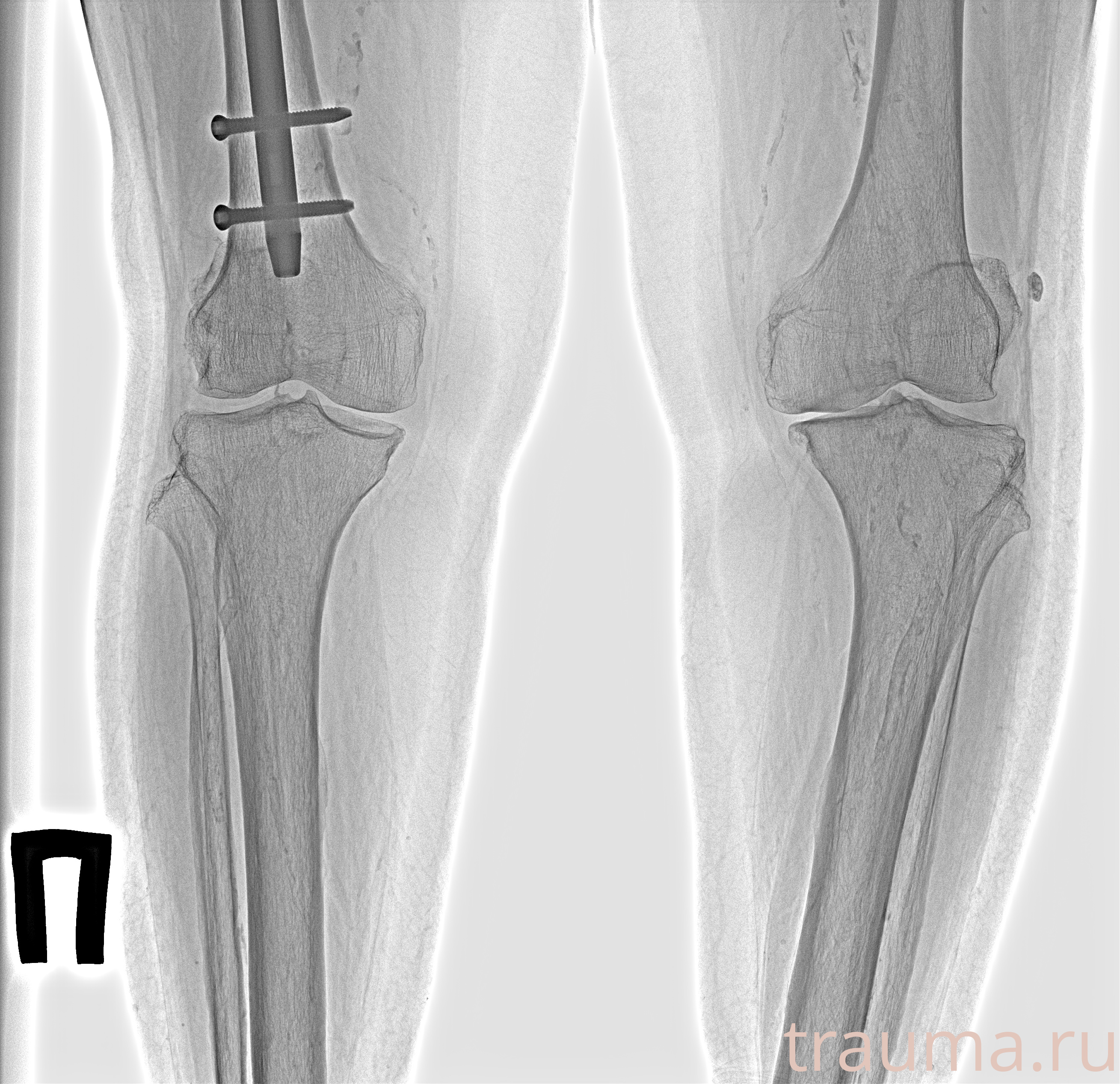Рентген на дому: по вашему адресу приезжает врач-рентгенолог, травматолог-ортопед с мобильным рентгеновским аппаратом, проводит диагностику травмы или заболевания, делает необходимые рентгенограммы, дает рекомендации по дальнейшему лечению. Получить качественные снимки в домашних условиях возможно благодаря уникальной методике, разработанной МосРентген Центром для института  Склифосовского