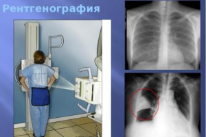 Курс медицинской рентгенологии. Рентгенодиагностика. Рентгенологическое исследование органов дыхания (легких и плевры).Часть 2. Глава 7.1 Курс медицинской рентгенологии. Рентгенодиагностика. Рентгенологическое исследование органов дыхания (легких и плевры).Часть 2. Глава 7.1