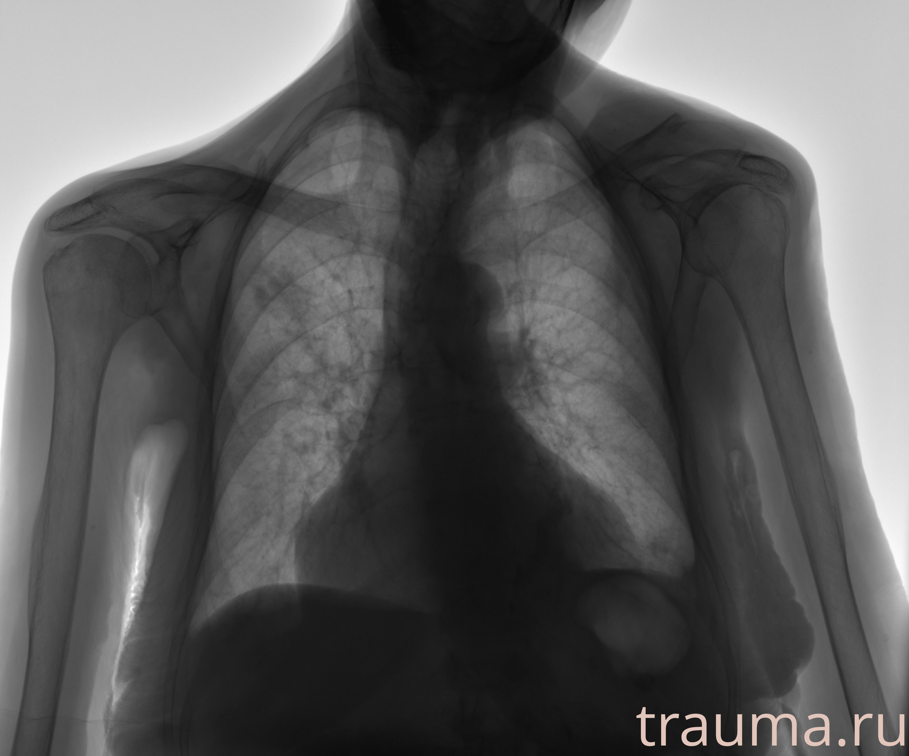 Рентген на дому: по вашему адресу приезжает врач-рентгенолог, травматолог-ортопед с мобильным рентгеновским аппаратом, проводит диагностику травмы или заболевания, делает необходимые рентгенограммы, дает рекомендации по дальнейшему лечению. Получить качественные снимки в домашних условиях возможно благодаря уникальной методике, разработанной МосРентген Центром для института  Склифосовского