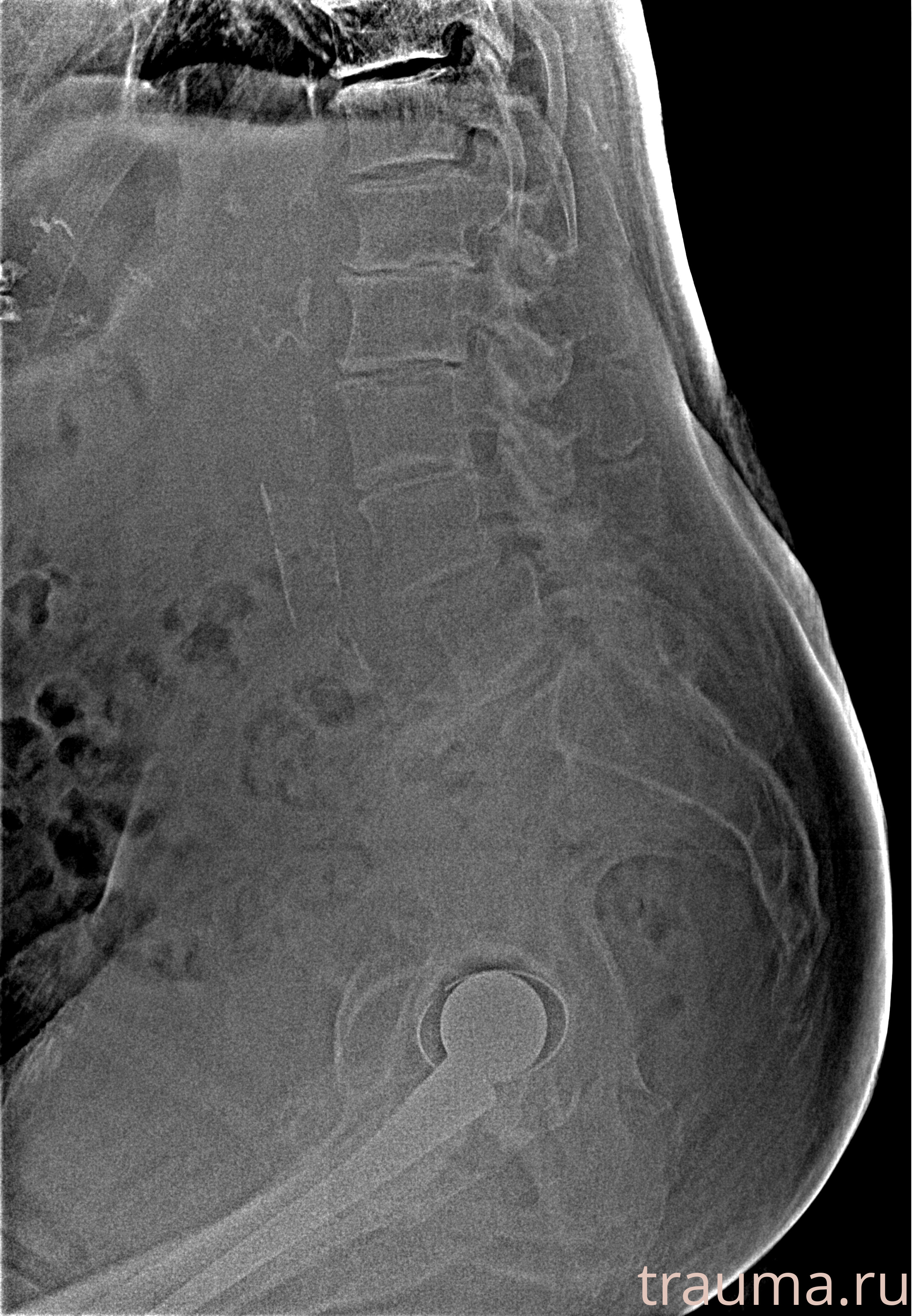Рентген на дому: по вашему адресу приезжает врач-рентгенолог, травматолог-ортопед с мобильным рентгеновским аппаратом, проводит диагностику травмы или заболевания, делает необходимые рентгенограммы, дает рекомендации по дальнейшему лечению. Получить качественные снимки в домашних условиях возможно благодаря уникальной методике, разработанной МосРентген Центром для института  Склифосовского