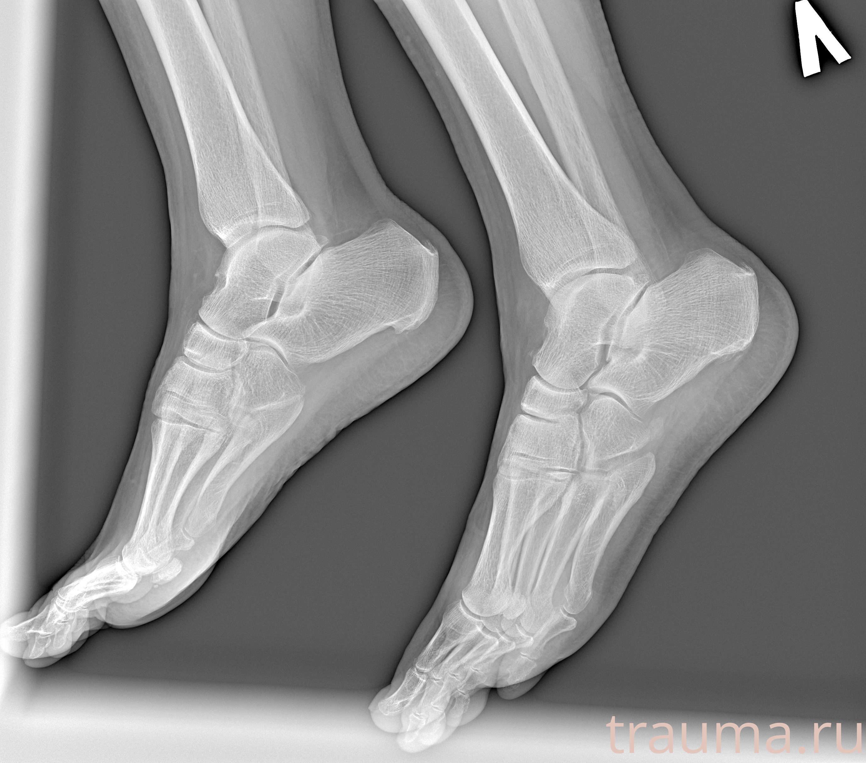 Рентген на дому: по вашему адресу приезжает врач-рентгенолог, травматолог-ортопед с мобильным рентгеновским аппаратом, проводит диагностику травмы или заболевания, делает необходимые рентгенограммы, дает рекомендации по дальнейшему лечению. Получить качественные снимки в домашних условиях возможно благодаря уникальной методике, разработанной МосРентген Центром для института  Склифосовского