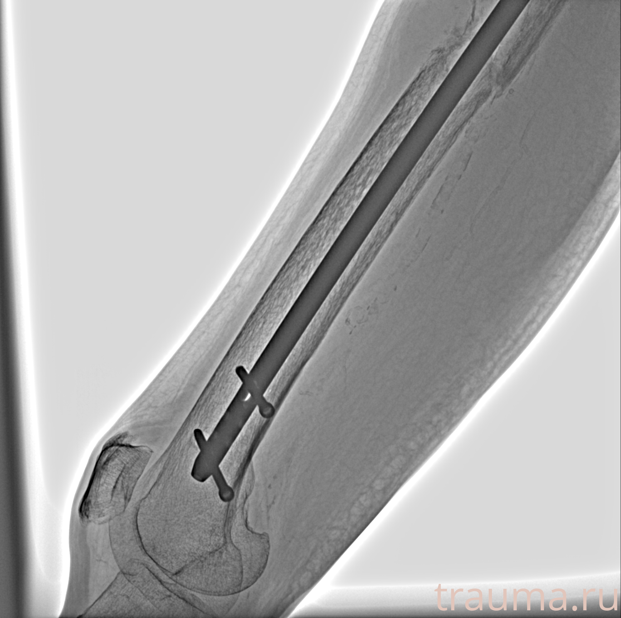 Рентген на дому: по вашему адресу приезжает врач-рентгенолог, травматолог-ортопед с мобильным рентгеновским аппаратом, проводит диагностику травмы или заболевания, делает необходимые рентгенограммы, дает рекомендации по дальнейшему лечению. Получить качественные снимки в домашних условиях возможно благодаря уникальной методике, разработанной МосРентген Центром для института  Склифосовского