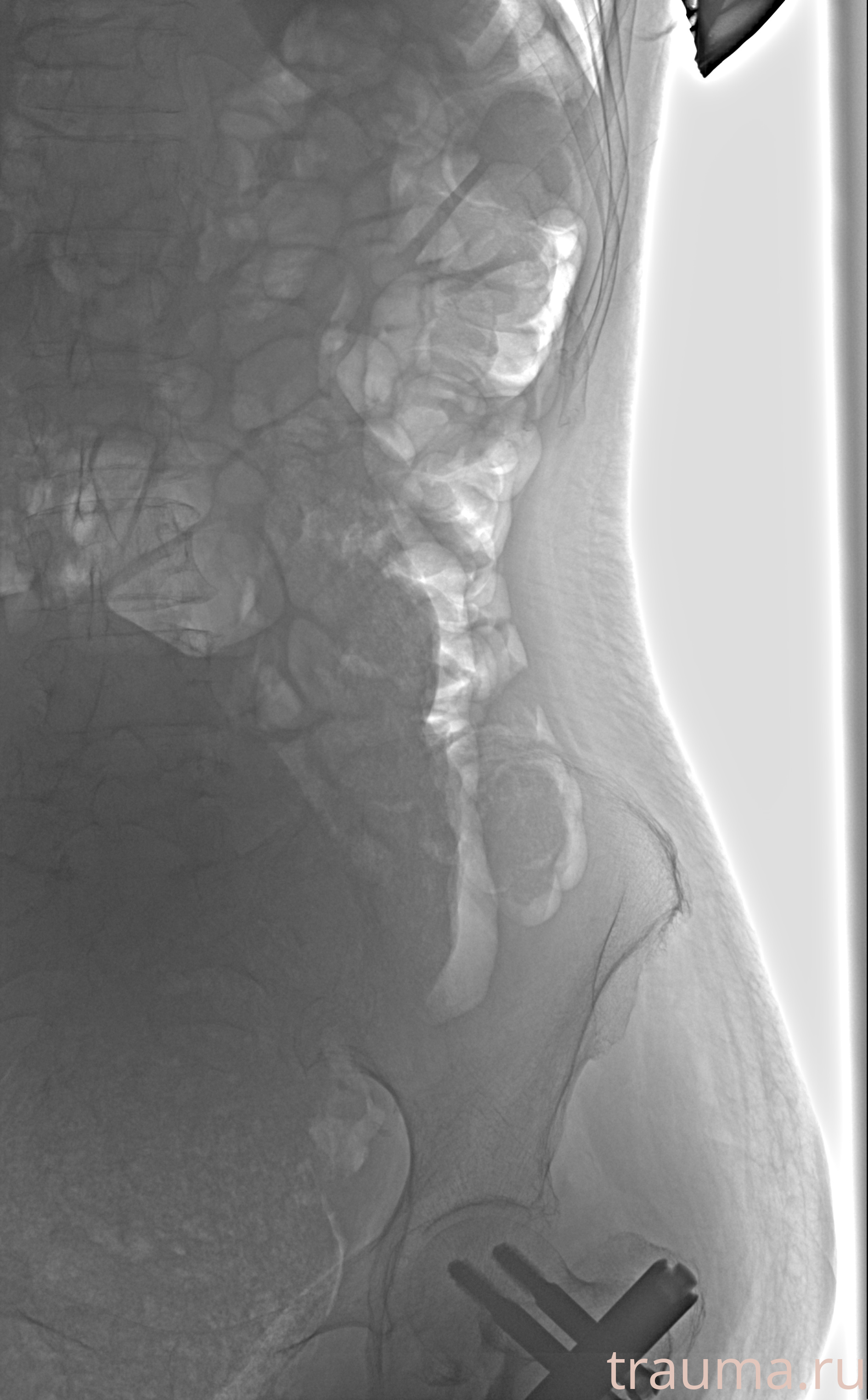 Рентген на дому: по вашему адресу приезжает врач-рентгенолог, травматолог-ортопед с мобильным рентгеновским аппаратом, проводит диагностику травмы или заболевания, делает необходимые рентгенограммы, дает рекомендации по дальнейшему лечению. Получить качественные снимки в домашних условиях возможно благодаря уникальной методике, разработанной МосРентген Центром для института  Склифосовского