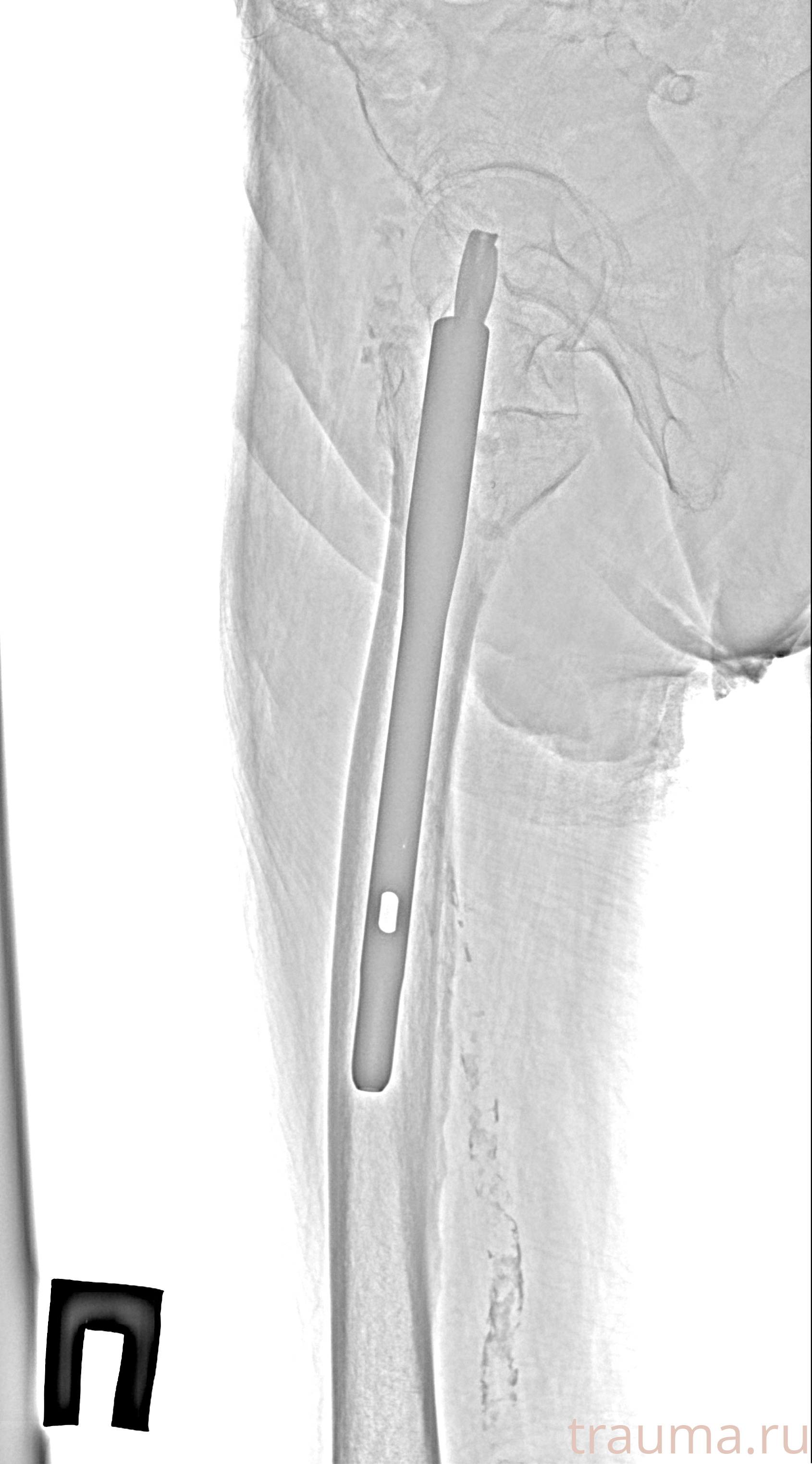 Рентген на дому: по вашему адресу приезжает врач-рентгенолог, травматолог-ортопед с мобильным рентгеновским аппаратом, проводит диагностику травмы или заболевания, делает необходимые рентгенограммы, дает рекомендации по дальнейшему лечению. Получить качественные снимки в домашних условиях возможно благодаря уникальной методике, разработанной МосРентген Центром для института  Склифосовского