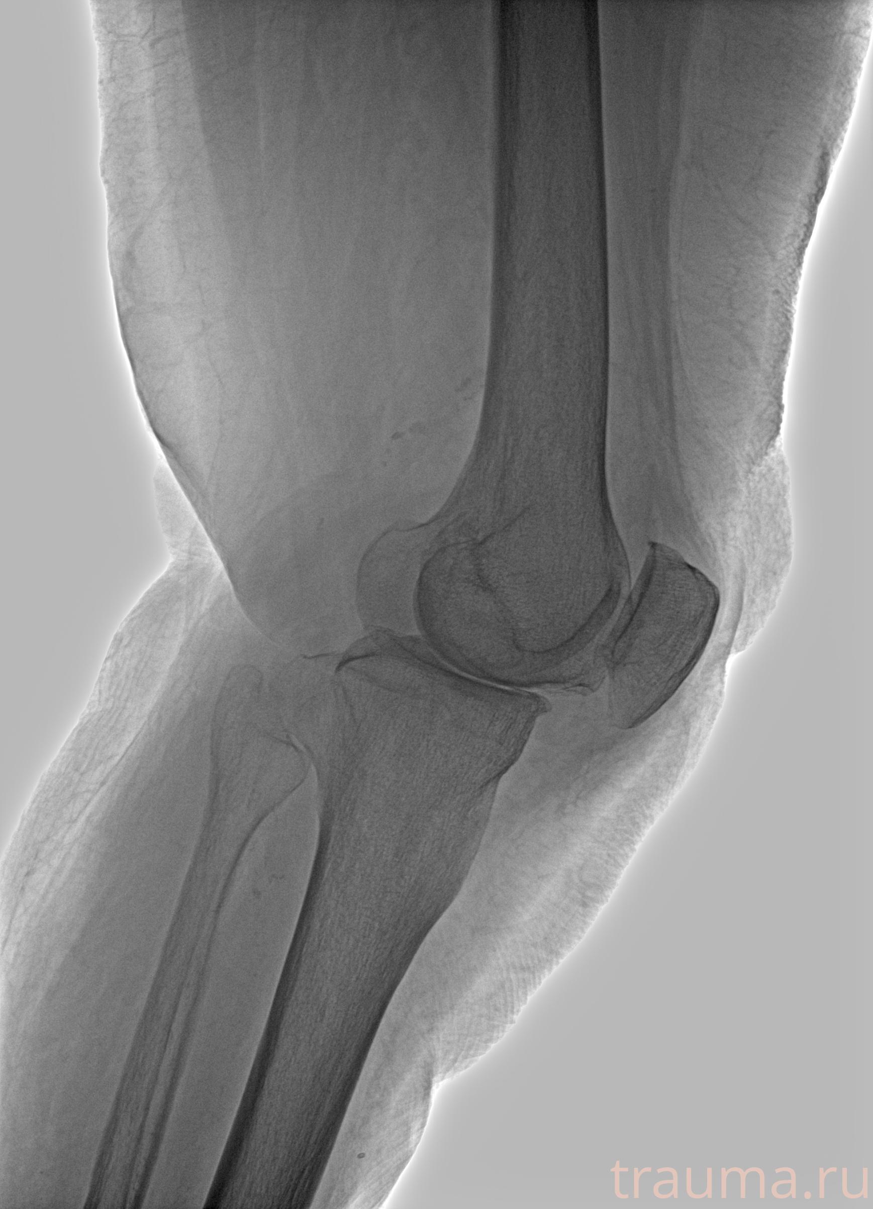 Рентген на дому: по вашему адресу приезжает врач-рентгенолог, травматолог-ортопед с мобильным рентгеновским аппаратом, проводит диагностику травмы или заболевания, делает необходимые рентгенограммы, дает рекомендации по дальнейшему лечению. Получить качественные снимки в домашних условиях возможно благодаря уникальной методике, разработанной МосРентген Центром для института  Склифосовского
