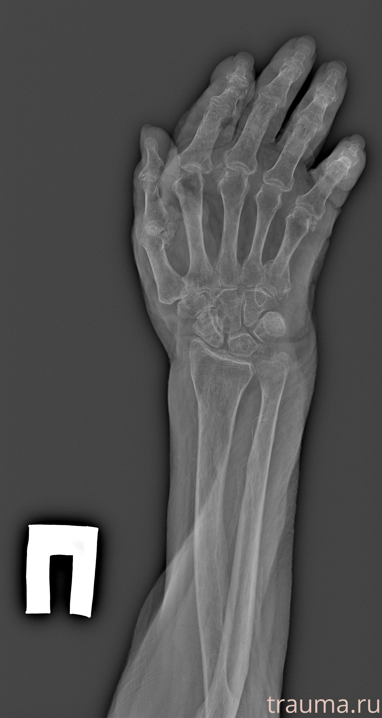 Рентген на дому: по вашему адресу приезжает врач-рентгенолог, травматолог-ортопед с мобильным рентгеновским аппаратом, проводит диагностику травмы или заболевания, делает необходимые рентгенограммы, дает рекомендации по дальнейшему лечению. Получить качественные снимки в домашних условиях возможно благодаря уникальной методике, разработанной МосРентген Центром для института  Склифосовского