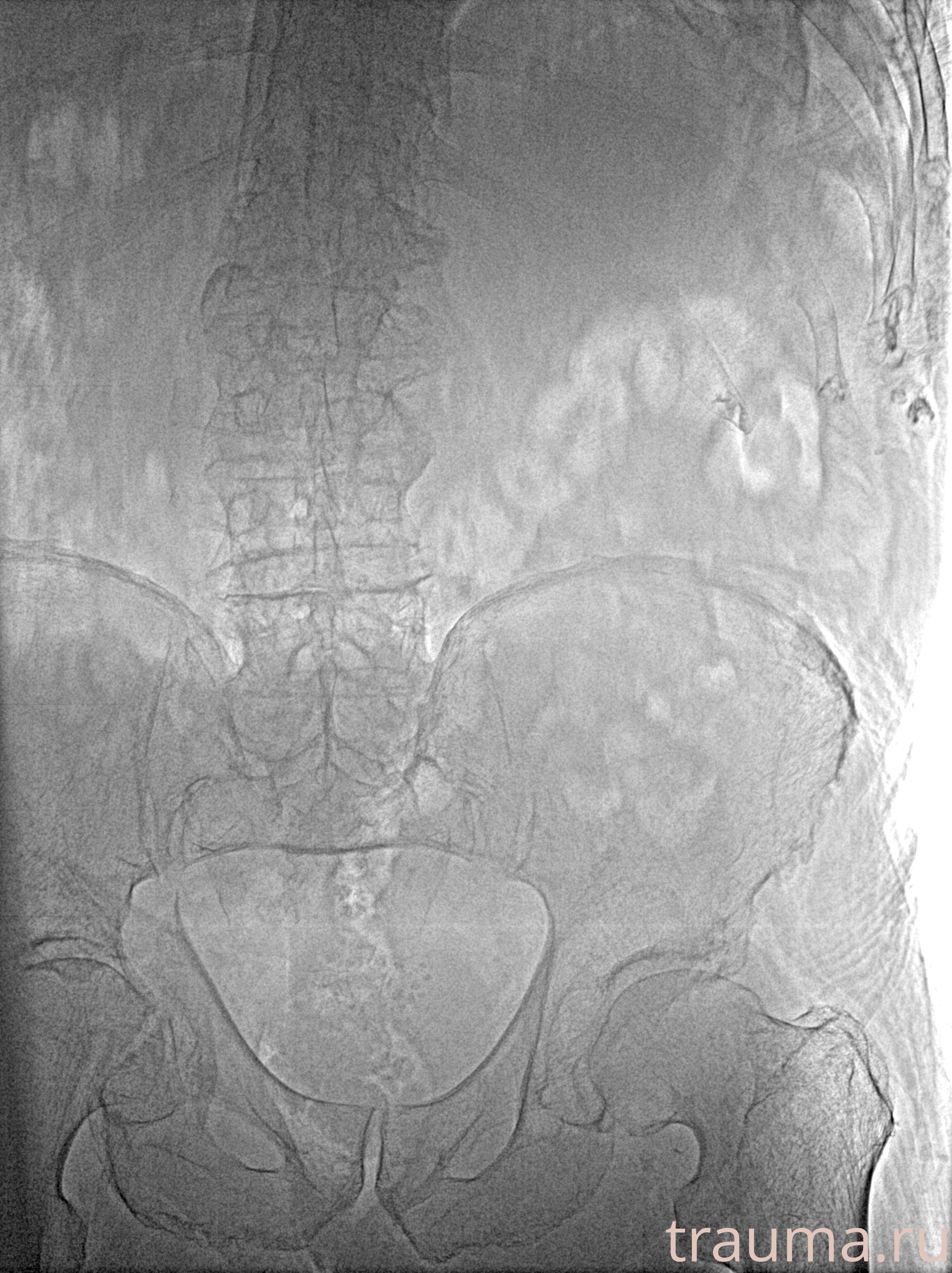 Рентген на дому: по вашему адресу приезжает врач-рентгенолог, травматолог-ортопед с мобильным рентгеновским аппаратом, проводит диагностику травмы или заболевания, делает необходимые рентгенограммы, дает рекомендации по дальнейшему лечению. Получить качественные снимки в домашних условиях возможно благодаря уникальной методике, разработанной МосРентген Центром для института  Склифосовского
