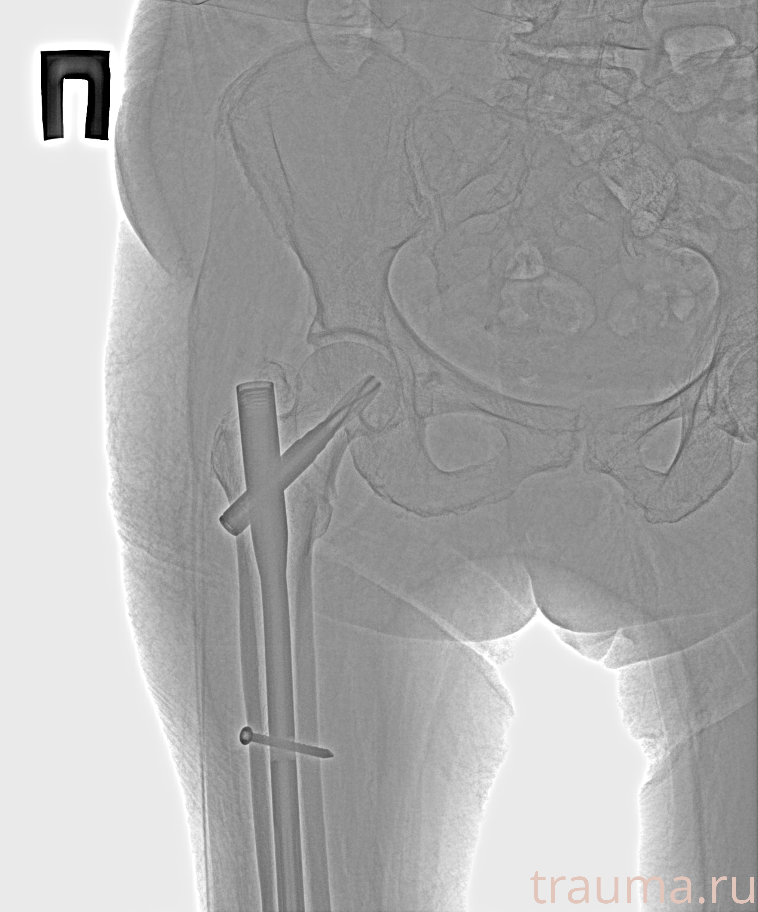 Рентген на дому: по вашему адресу приезжает врач-рентгенолог, травматолог-ортопед с мобильным рентгеновским аппаратом, проводит диагностику травмы или заболевания, делает необходимые рентгенограммы, дает рекомендации по дальнейшему лечению. Получить качественные снимки в домашних условиях возможно благодаря уникальной методике, разработанной МосРентген Центром для института  Склифосовского