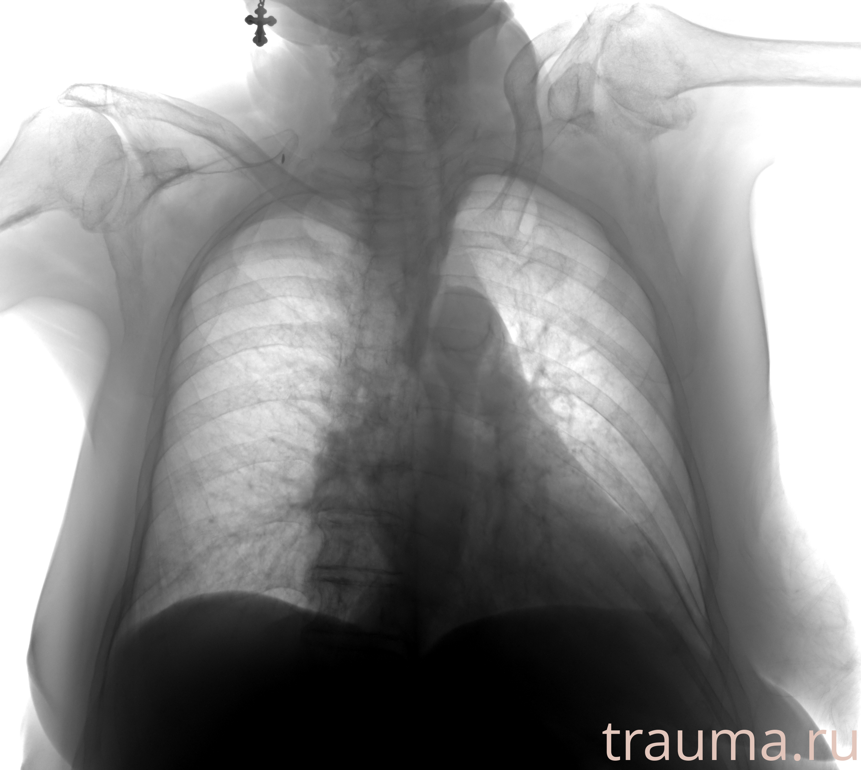 Рентген на дому: по вашему адресу приезжает врач-рентгенолог, травматолог-ортопед с мобильным рентгеновским аппаратом, проводит диагностику травмы или заболевания, делает необходимые рентгенограммы, дает рекомендации по дальнейшему лечению. Получить качественные снимки в домашних условиях возможно благодаря уникальной методике, разработанной МосРентген Центром для института  Склифосовского