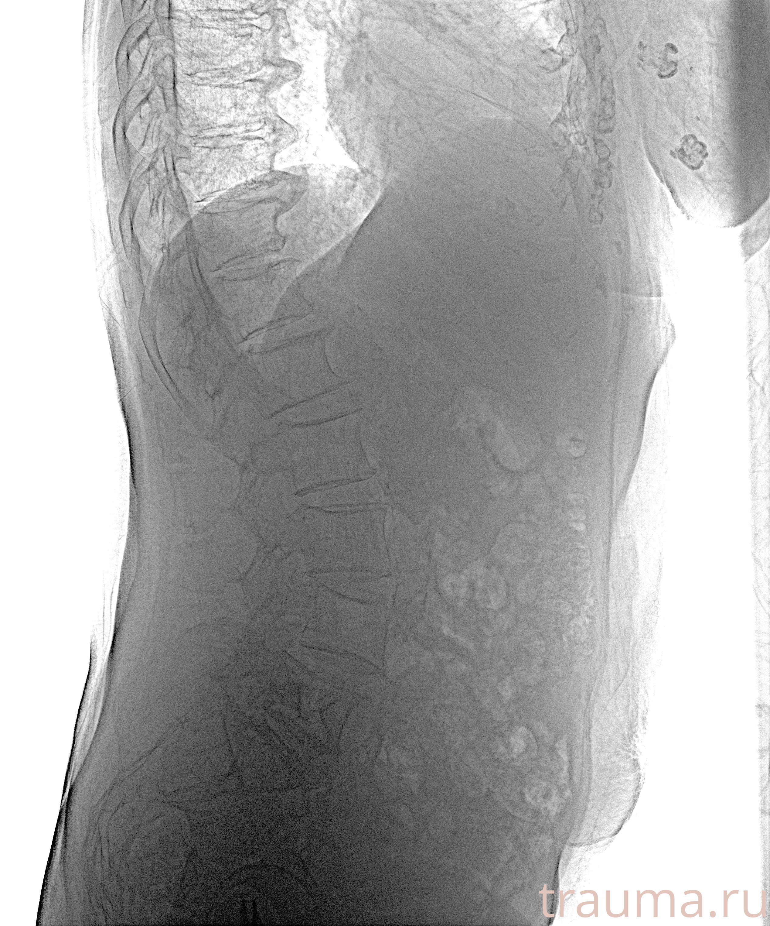 Рентген на дому: по вашему адресу приезжает врач-рентгенолог, травматолог-ортопед с мобильным рентгеновским аппаратом, проводит диагностику травмы или заболевания, делает необходимые рентгенограммы, дает рекомендации по дальнейшему лечению. Получить качественные снимки в домашних условиях возможно благодаря уникальной методике, разработанной МосРентген Центром для института  Склифосовского