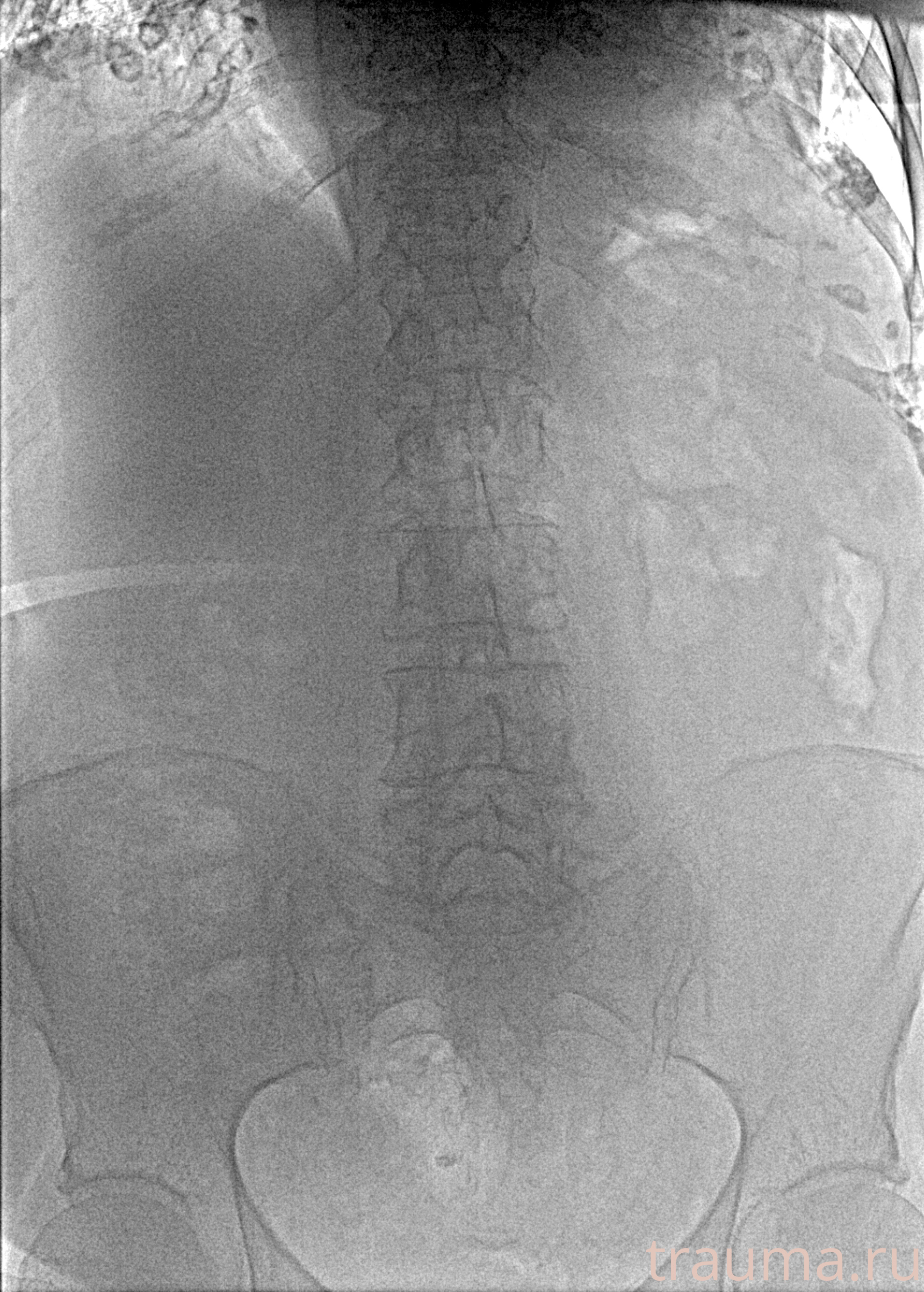 Рентген на дому: по вашему адресу приезжает врач-рентгенолог, травматолог-ортопед с мобильным рентгеновским аппаратом, проводит диагностику травмы или заболевания, делает необходимые рентгенограммы, дает рекомендации по дальнейшему лечению. Получить качественные снимки в домашних условиях возможно благодаря уникальной методике, разработанной МосРентген Центром для института  Склифосовского