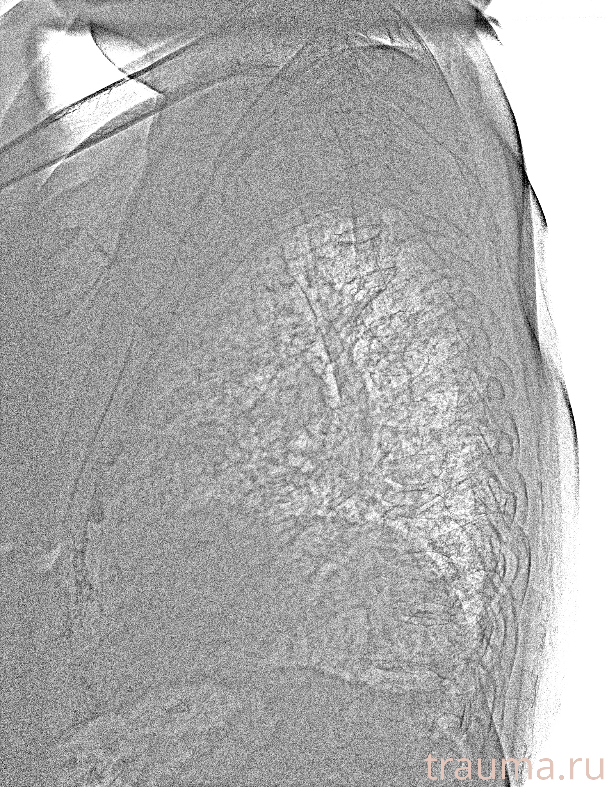 Рентген на дому: по вашему адресу приезжает врач-рентгенолог, травматолог-ортопед с мобильным рентгеновским аппаратом, проводит диагностику травмы или заболевания, делает необходимые рентгенограммы, дает рекомендации по дальнейшему лечению. Получить качественные снимки в домашних условиях возможно благодаря уникальной методике, разработанной МосРентген Центром для института  Склифосовского
