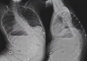 Патогенетическая терапия у детей со спинальной мышечной атрофией Патогенетическая терапия у детей со спинальной мышечной атрофией