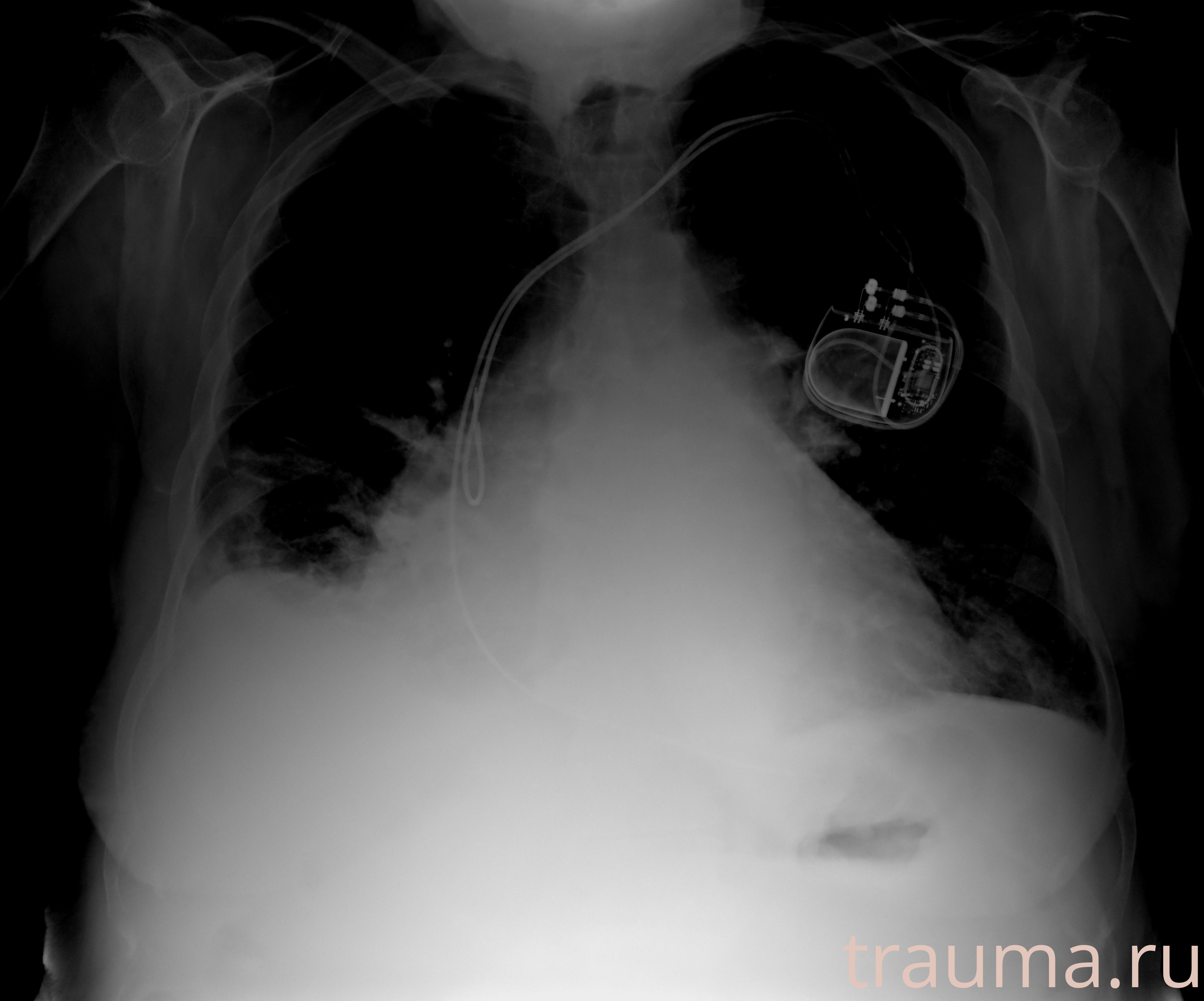 Рентген на дому: по вашему адресу приезжает врач-рентгенолог, травматолог-ортопед с мобильным рентгеновским аппаратом, проводит диагностику травмы или заболевания, делает необходимые рентгенограммы, дает рекомендации по дальнейшему лечению. Получить качественные снимки в домашних условиях возможно благодаря уникальной методике, разработанной МосРентген Центром для института  Склифосовского