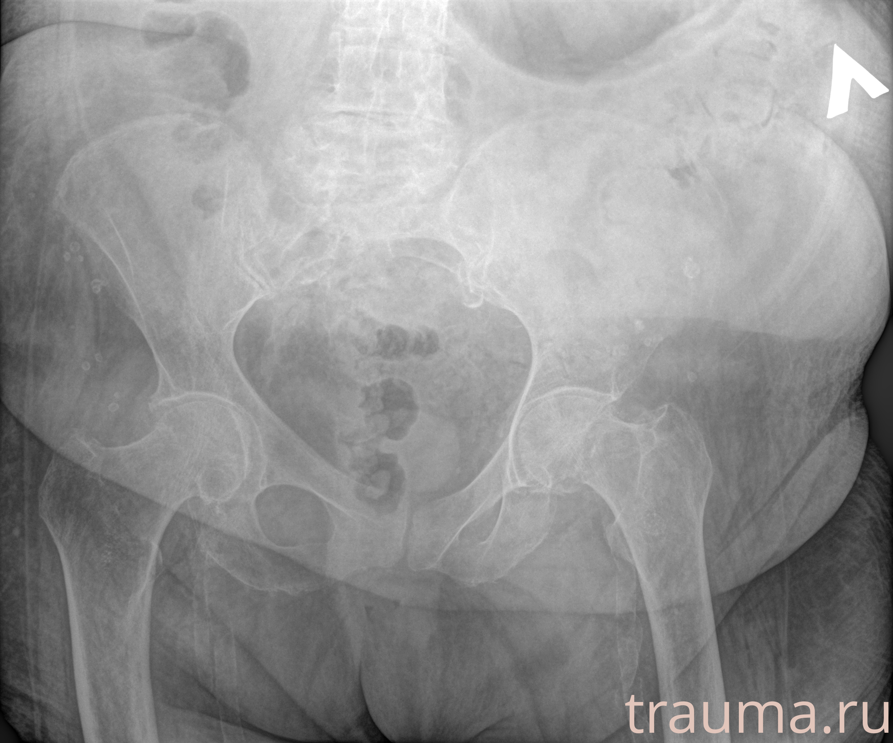 Рентген на дому: по вашему адресу приезжает врач-рентгенолог, травматолог-ортопед с мобильным рентгеновским аппаратом, проводит диагностику травмы или заболевания, делает необходимые рентгенограммы, дает рекомендации по дальнейшему лечению. Получить качественные снимки в домашних условиях возможно благодаря уникальной методике, разработанной МосРентген Центром для института  Склифосовского