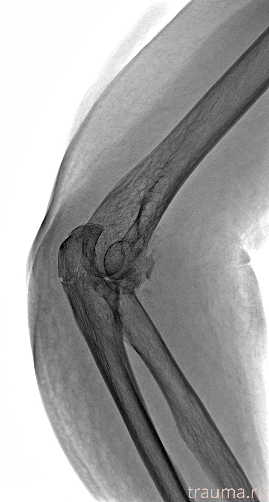 Рентген на дому: по вашему адресу приезжает врач-рентгенолог, травматолог-ортопед с мобильным рентгеновским аппаратом, проводит диагностику травмы или заболевания, делает необходимые рентгенограммы, дает рекомендации по дальнейшему лечению. Получить качественные снимки в домашних условиях возможно благодаря уникальной методике, разработанной МосРентген Центром для института  Склифосовского