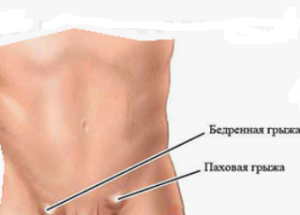 Паховая и бедренная грыжа Паховая и бедренная грыжа