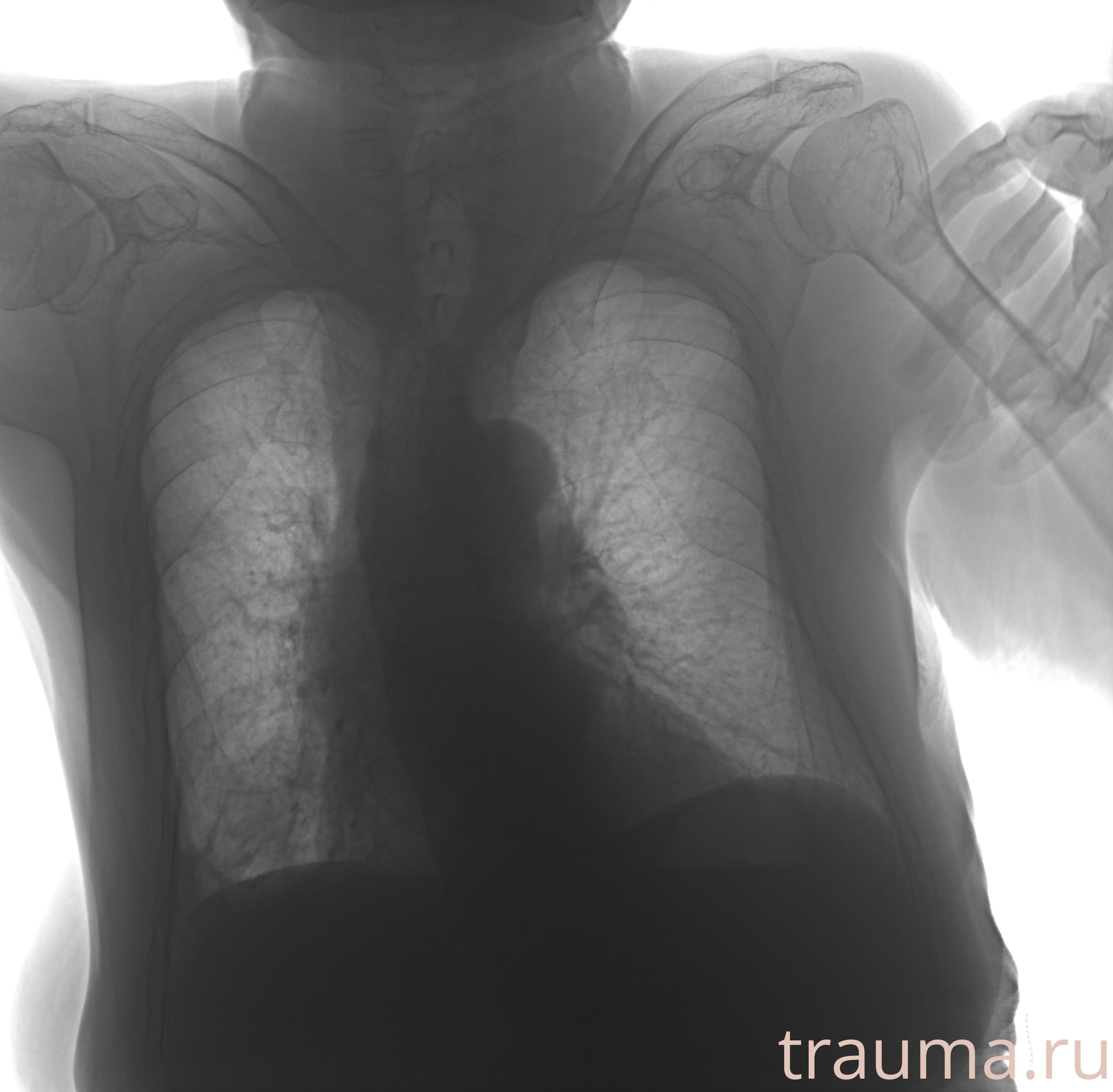 Рентген на дому: по вашему адресу приезжает врач-рентгенолог, травматолог-ортопед с мобильным рентгеновским аппаратом, проводит диагностику травмы или заболевания, делает необходимые рентгенограммы, дает рекомендации по дальнейшему лечению. Получить качественные снимки в домашних условиях возможно благодаря уникальной методике, разработанной МосРентген Центром для института  Склифосовского