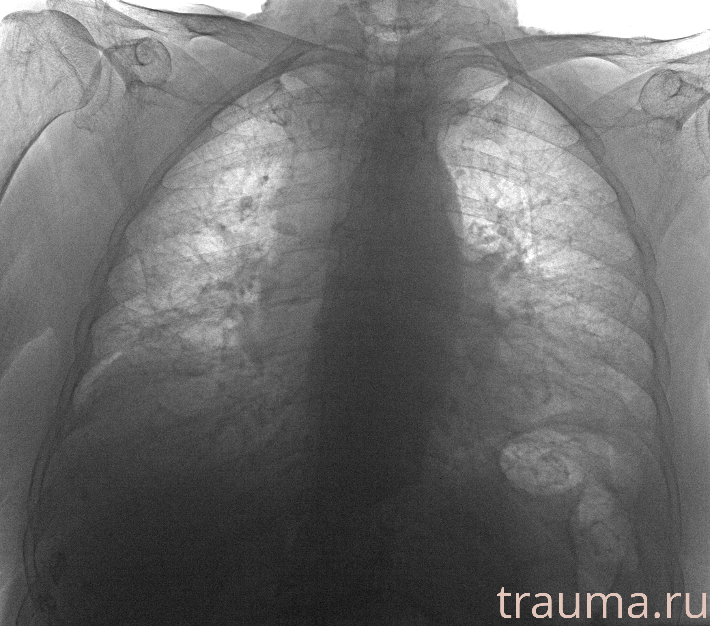 Рентген на дому: по вашему адресу приезжает врач-рентгенолог, травматолог-ортопед с мобильным рентгеновским аппаратом, проводит диагностику травмы или заболевания, делает необходимые рентгенограммы, дает рекомендации по дальнейшему лечению. Получить качественные снимки в домашних условиях возможно благодаря уникальной методике, разработанной МосРентген Центром для института  Склифосовского