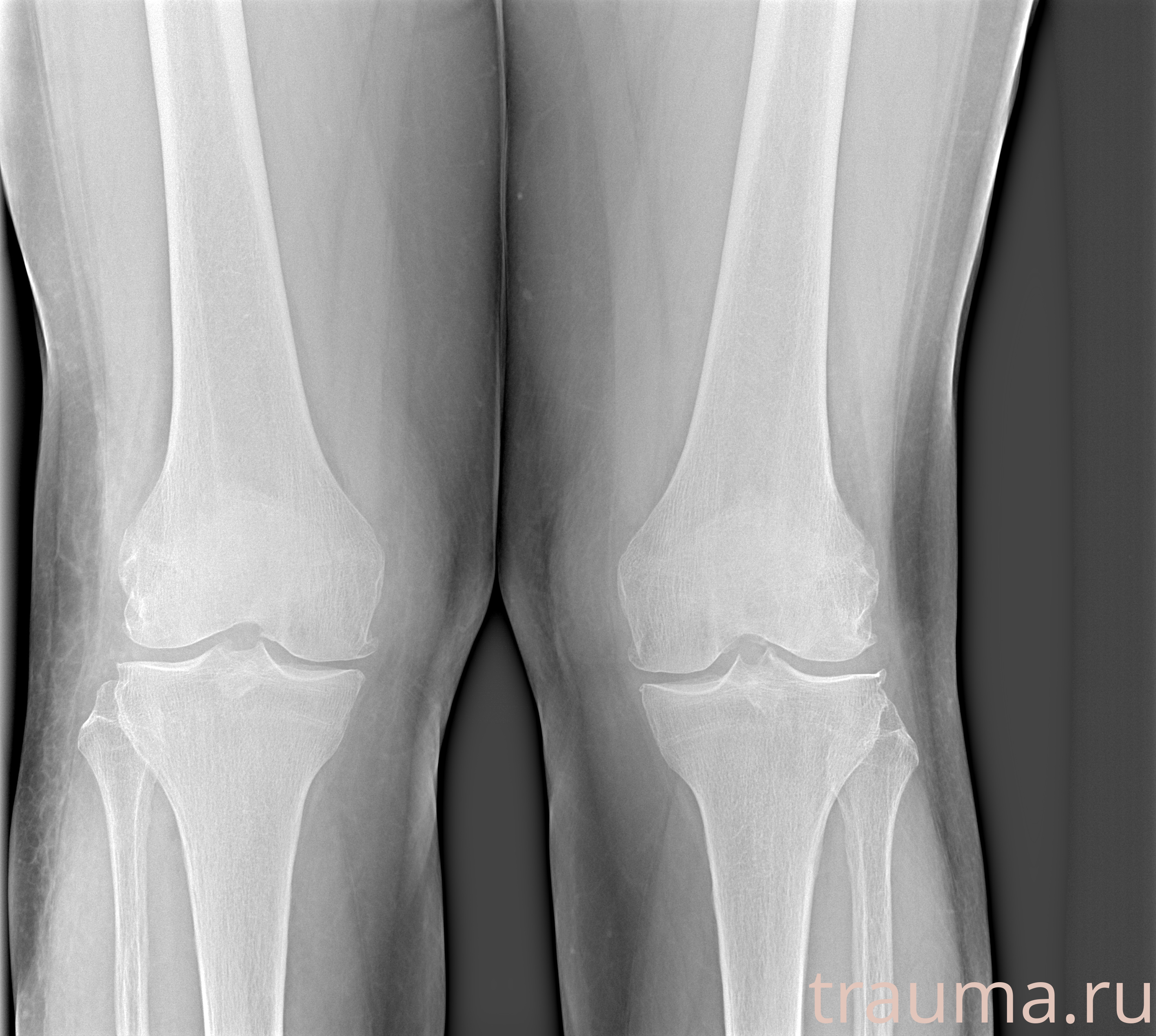 Рентген на дому: по вашему адресу приезжает врач-рентгенолог, травматолог-ортопед с мобильным рентгеновским аппаратом, проводит диагностику травмы или заболевания, делает необходимые рентгенограммы, дает рекомендации по дальнейшему лечению. Получить качественные снимки в домашних условиях возможно благодаря уникальной методике, разработанной МосРентген Центром для института  Склифосовского