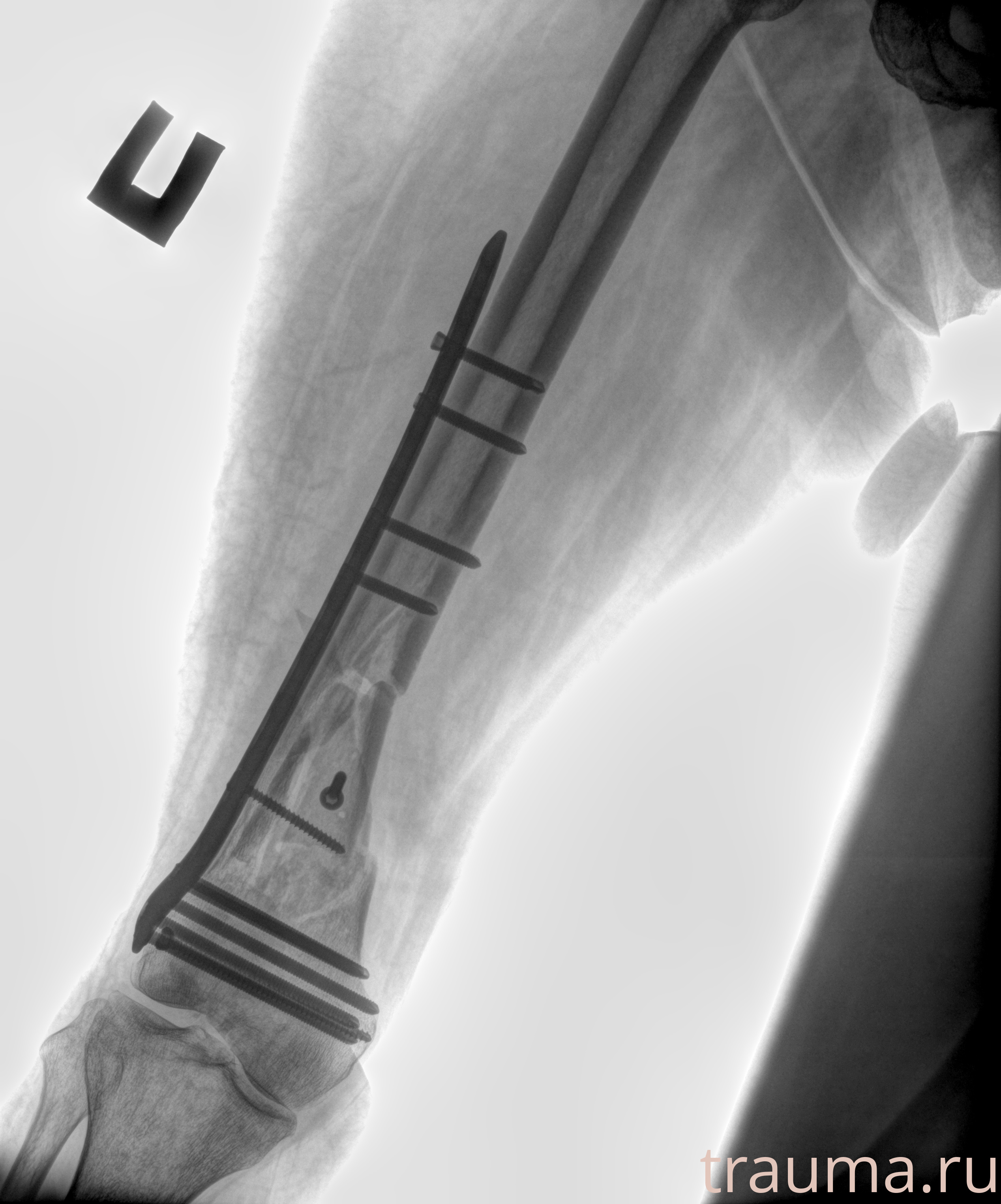 Рентген на дому: по вашему адресу приезжает врач-рентгенолог, травматолог-ортопед с мобильным рентгеновским аппаратом, проводит диагностику травмы или заболевания, делает необходимые рентгенограммы, дает рекомендации по дальнейшему лечению. Получить качественные снимки в домашних условиях возможно благодаря уникальной методике, разработанной МосРентген Центром для института  Склифосовского