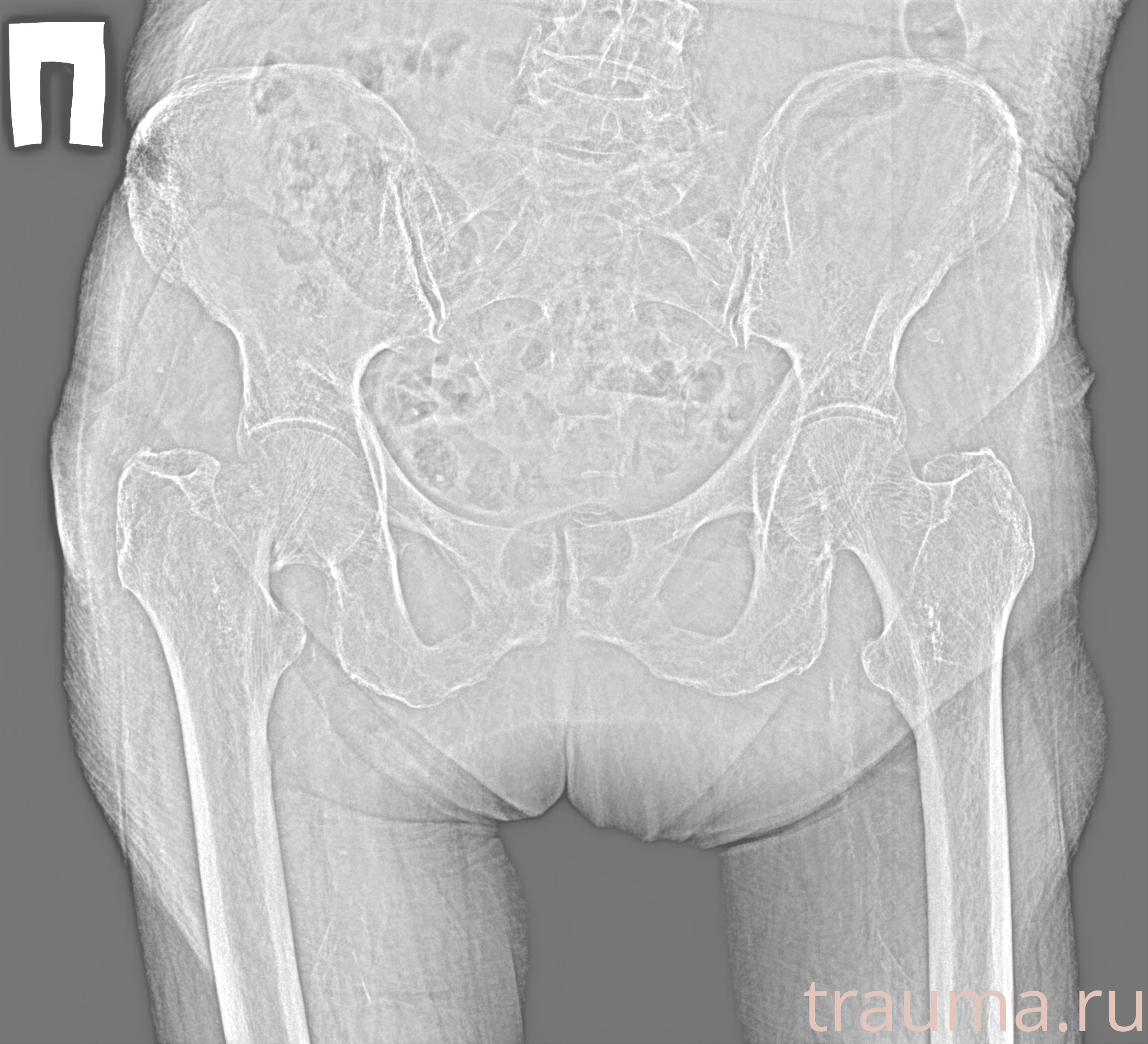 Рентген на дому: по вашему адресу приезжает врач-рентгенолог, травматолог-ортопед с мобильным рентгеновским аппаратом, проводит диагностику травмы или заболевания, делает необходимые рентгенограммы, дает рекомендации по дальнейшему лечению. Получить качественные снимки в домашних условиях возможно благодаря уникальной методике, разработанной МосРентген Центром для института  Склифосовского