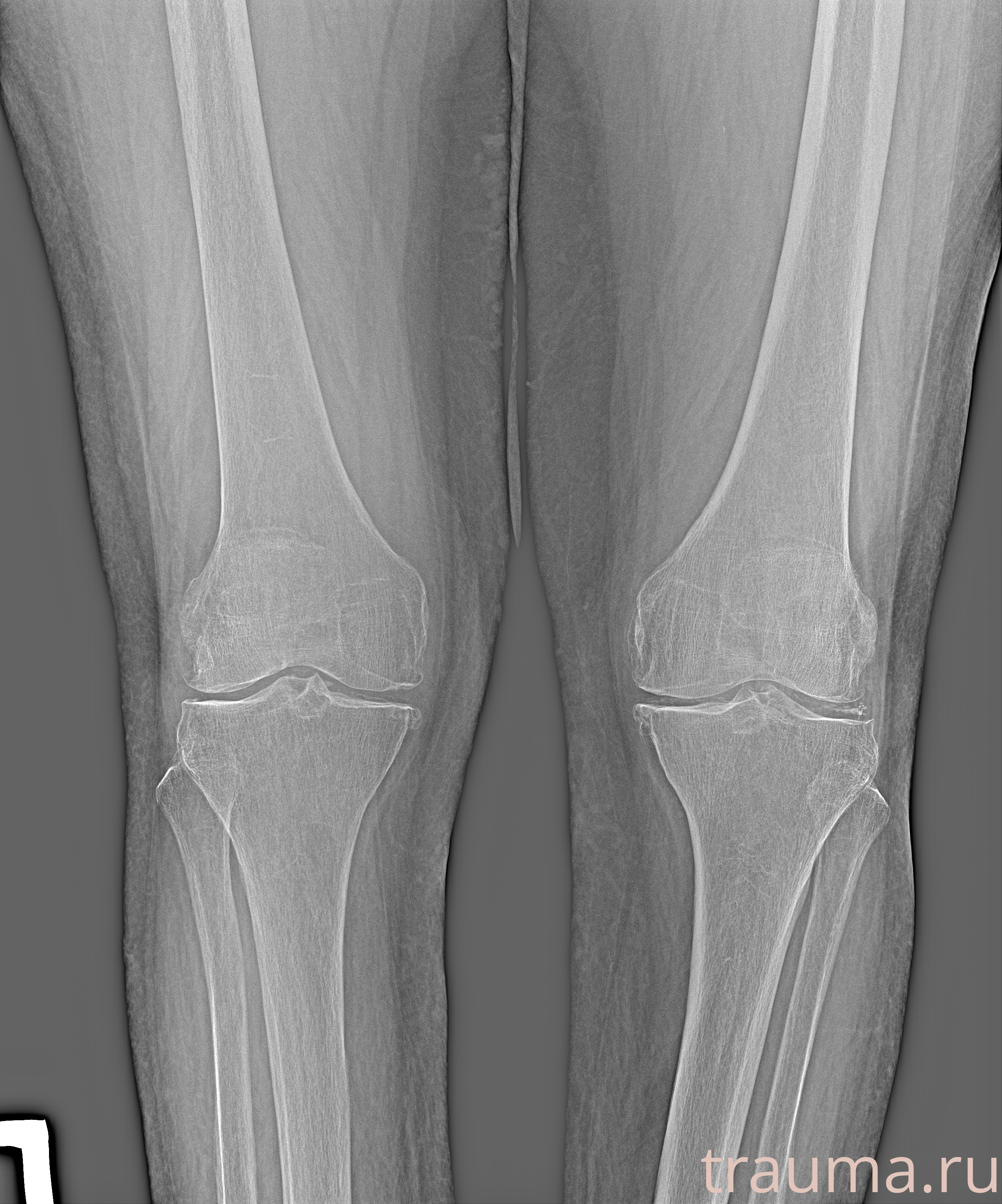 Рентген на дому: по вашему адресу приезжает врач-рентгенолог, травматолог-ортопед с мобильным рентгеновским аппаратом, проводит диагностику травмы или заболевания, делает необходимые рентгенограммы, дает рекомендации по дальнейшему лечению. Получить качественные снимки в домашних условиях возможно благодаря уникальной методике, разработанной МосРентген Центром для института  Склифосовского