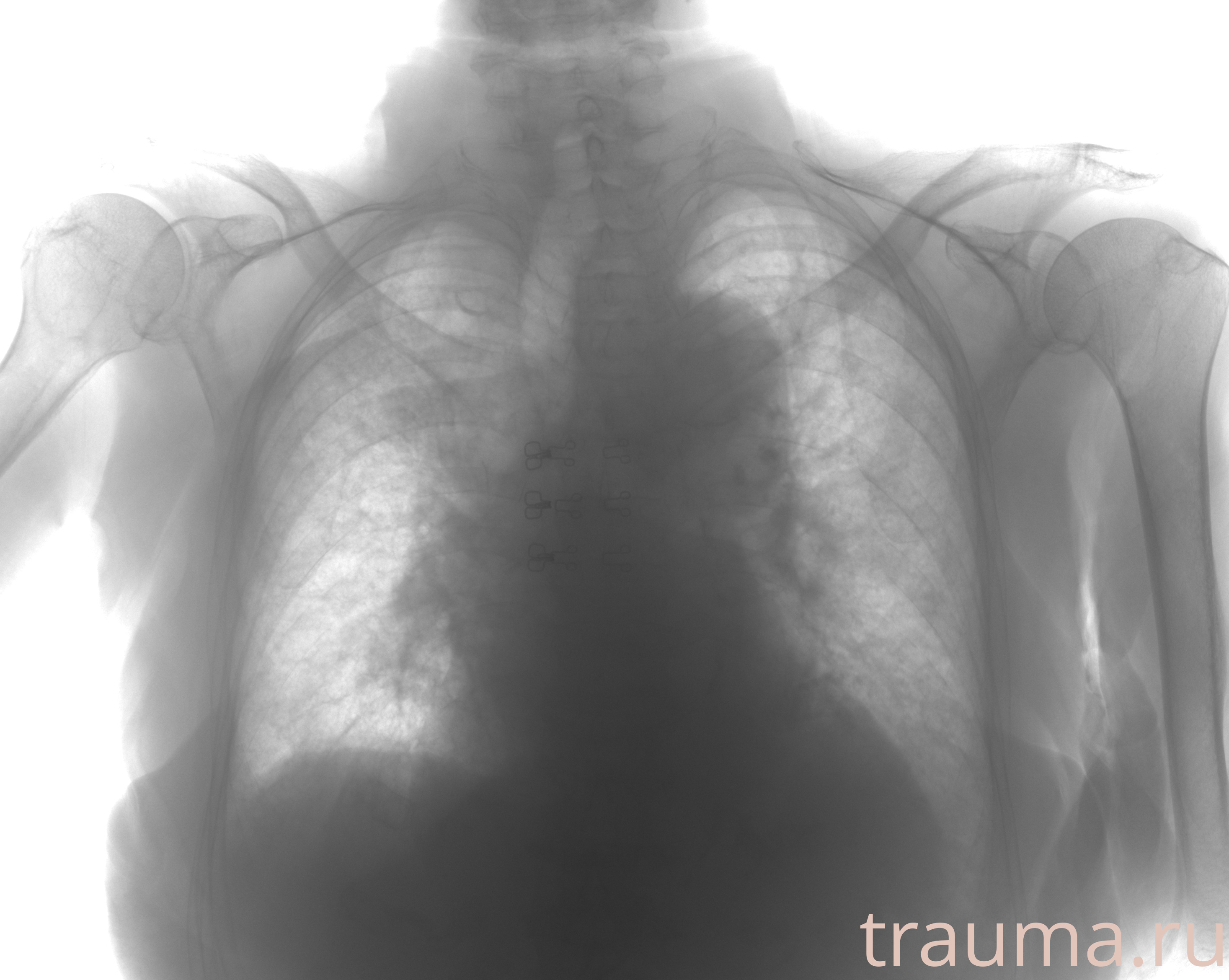 Рентген на дому: по вашему адресу приезжает врач-рентгенолог, травматолог-ортопед с мобильным рентгеновским аппаратом, проводит диагностику травмы или заболевания, делает необходимые рентгенограммы, дает рекомендации по дальнейшему лечению. Получить качественные снимки в домашних условиях возможно благодаря уникальной методике, разработанной МосРентген Центром для института  Склифосовского