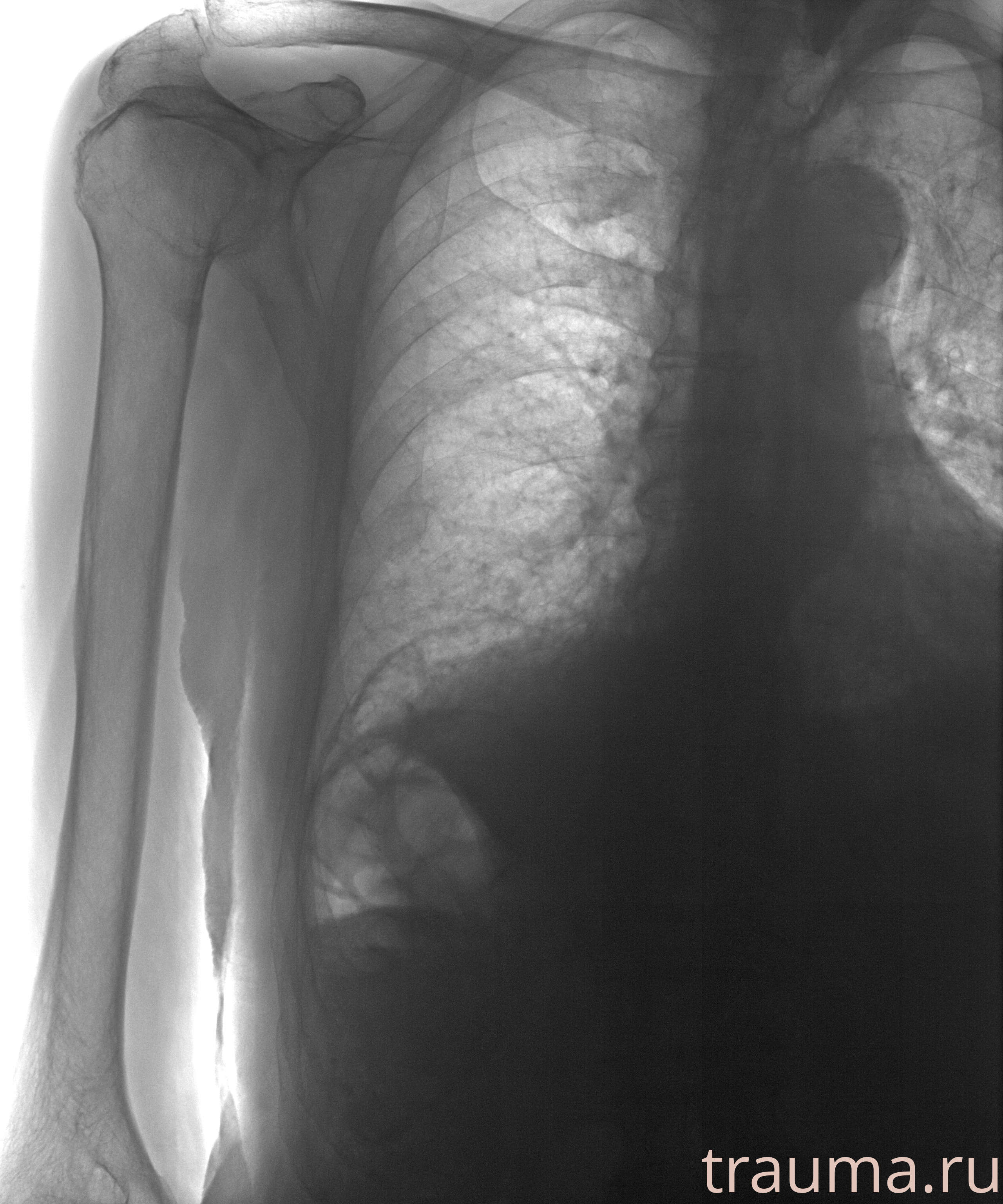 Рентген на дому: по вашему адресу приезжает врач-рентгенолог, травматолог-ортопед с мобильным рентгеновским аппаратом, проводит диагностику травмы или заболевания, делает необходимые рентгенограммы, дает рекомендации по дальнейшему лечению. Получить качественные снимки в домашних условиях возможно благодаря уникальной методике, разработанной МосРентген Центром для института  Склифосовского