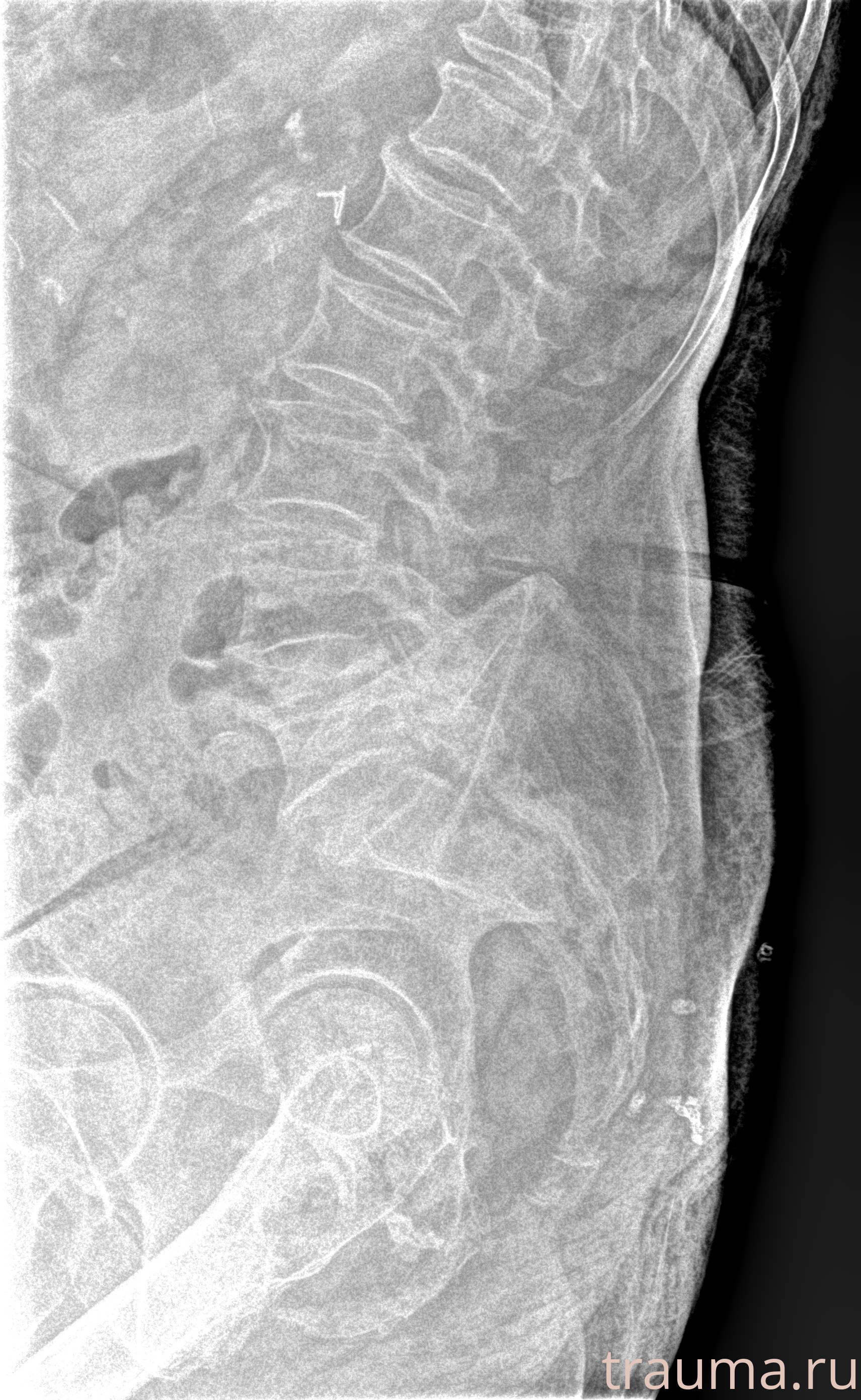 Рентген на дому: по вашему адресу приезжает врач-рентгенолог, травматолог-ортопед с мобильным рентгеновским аппаратом, проводит диагностику травмы или заболевания, делает необходимые рентгенограммы, дает рекомендации по дальнейшему лечению. Получить качественные снимки в домашних условиях возможно благодаря уникальной методике, разработанной МосРентген Центром для института  Склифосовского