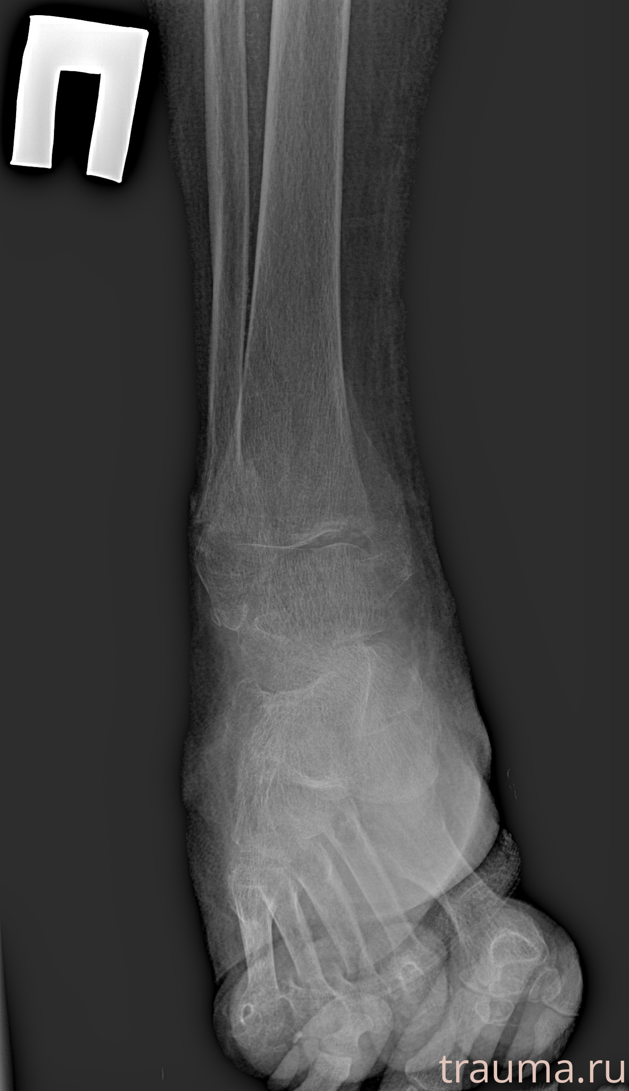 Рентген на дому: по вашему адресу приезжает врач-рентгенолог, травматолог-ортопед с мобильным рентгеновским аппаратом, проводит диагностику травмы или заболевания, делает необходимые рентгенограммы, дает рекомендации по дальнейшему лечению. Получить качественные снимки в домашних условиях возможно благодаря уникальной методике, разработанной МосРентген Центром для института  Склифосовского