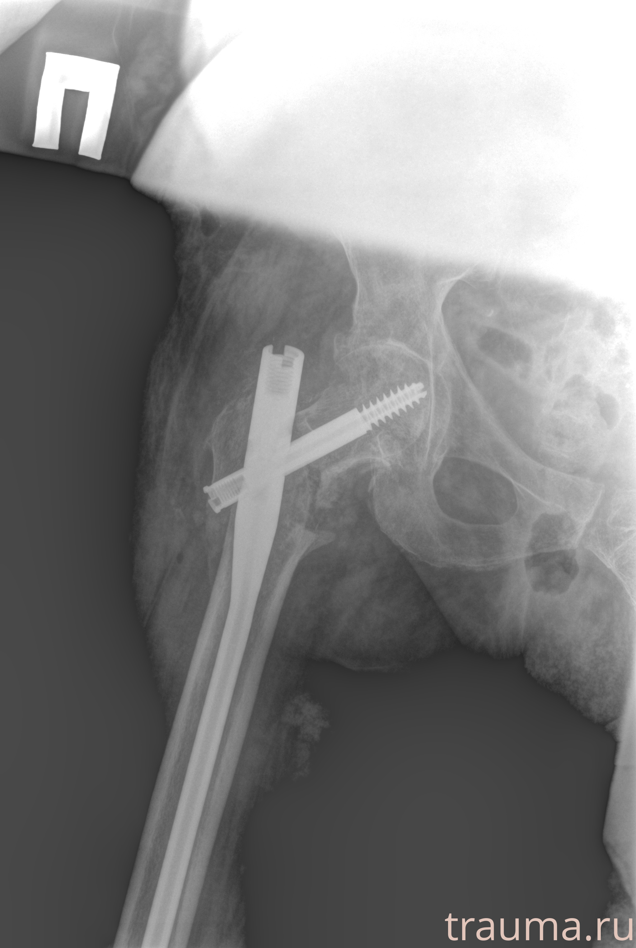 Рентген на дому: по вашему адресу приезжает врач-рентгенолог, травматолог-ортопед с мобильным рентгеновским аппаратом, проводит диагностику травмы или заболевания, делает необходимые рентгенограммы, дает рекомендации по дальнейшему лечению. Получить качественные снимки в домашних условиях возможно благодаря уникальной методике, разработанной МосРентген Центром для института  Склифосовского