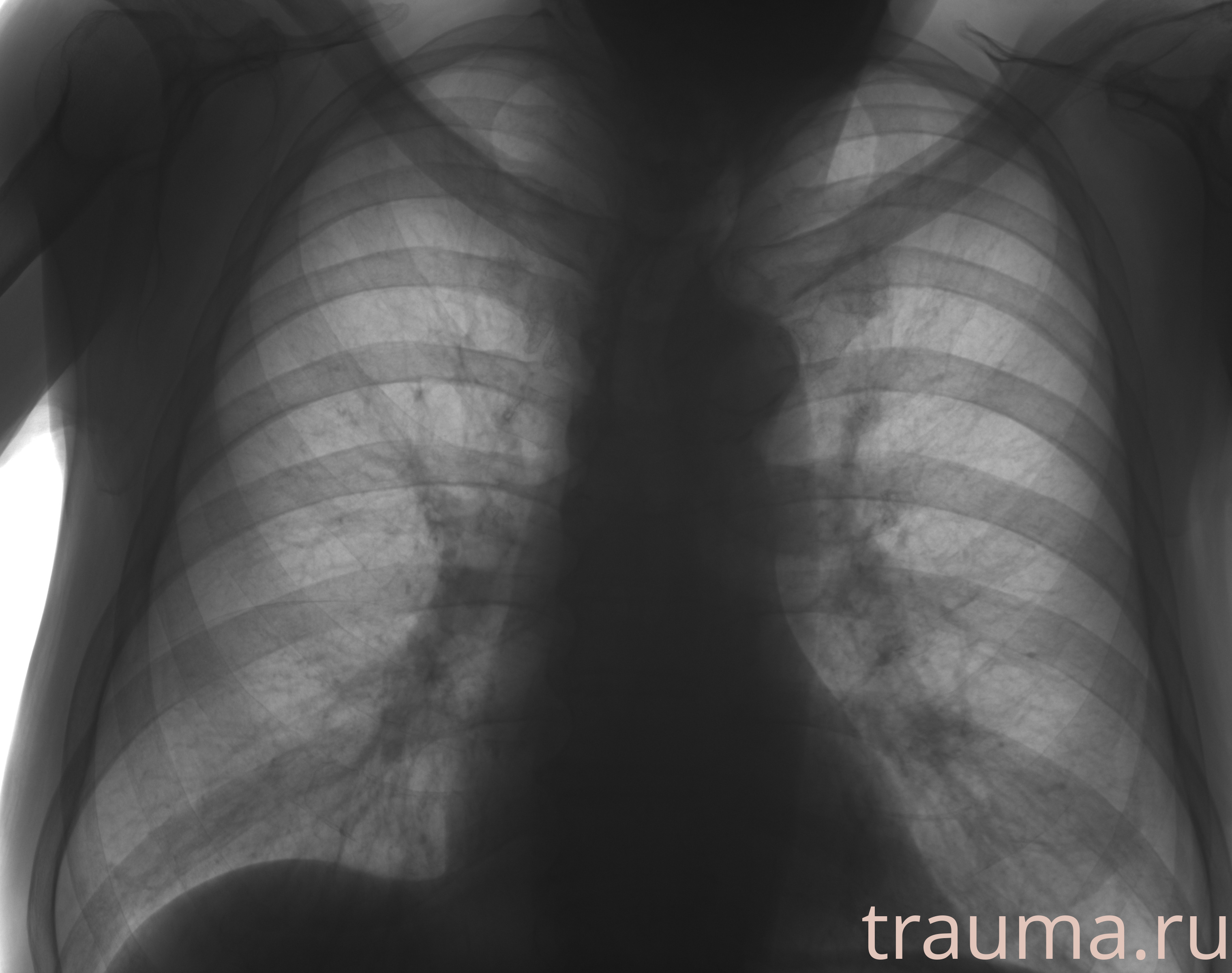 Рентген на дому: по вашему адресу приезжает врач-рентгенолог, травматолог-ортопед с мобильным рентгеновским аппаратом, проводит диагностику травмы или заболевания, делает необходимые рентгенограммы, дает рекомендации по дальнейшему лечению. Получить качественные снимки в домашних условиях возможно благодаря уникальной методике, разработанной МосРентген Центром для института  Склифосовского