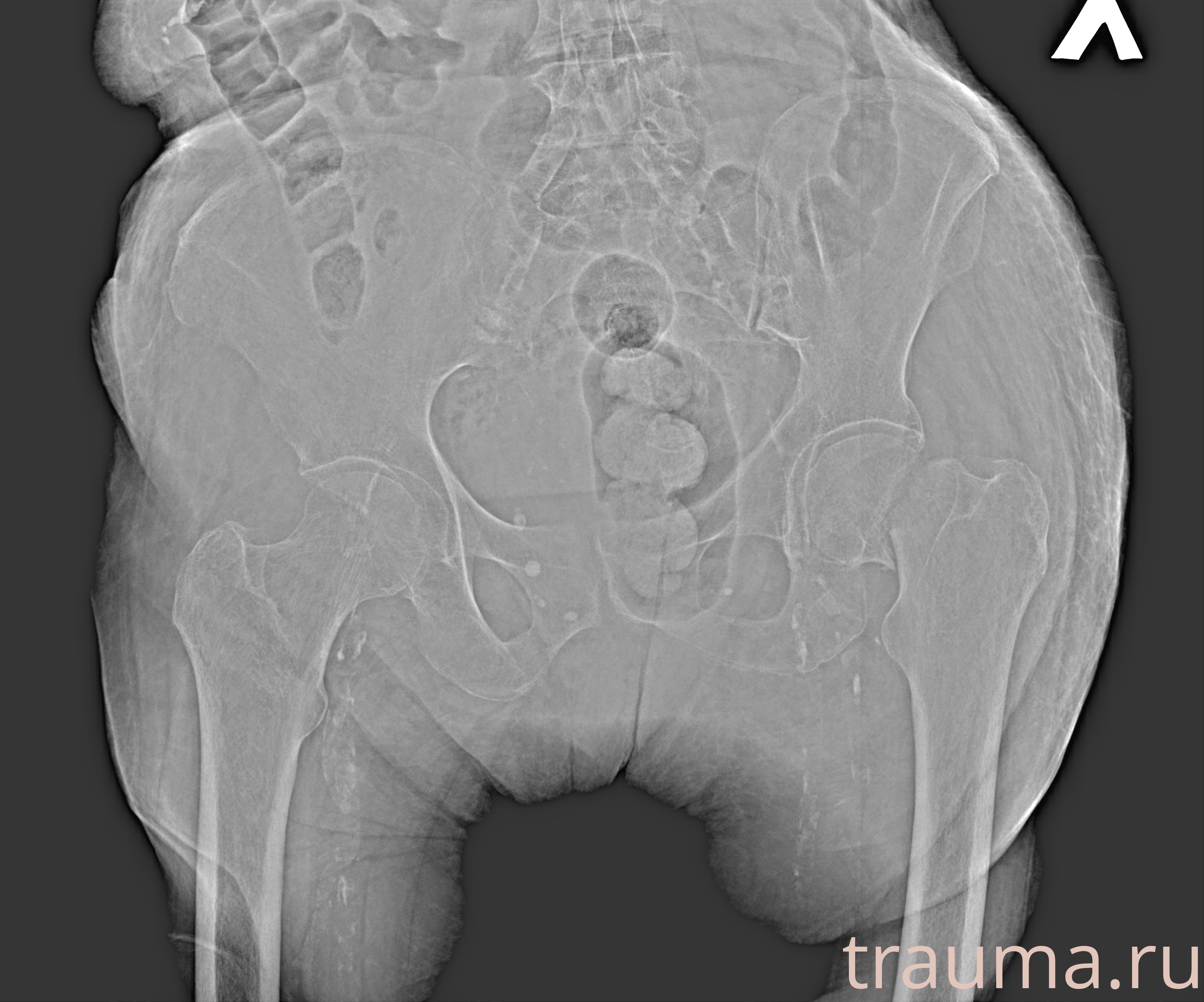 Рентген на дому: по вашему адресу приезжает врач-рентгенолог, травматолог-ортопед с мобильным рентгеновским аппаратом, проводит диагностику травмы или заболевания, делает необходимые рентгенограммы, дает рекомендации по дальнейшему лечению. Получить качественные снимки в домашних условиях возможно благодаря уникальной методике, разработанной МосРентген Центром для института  Склифосовского