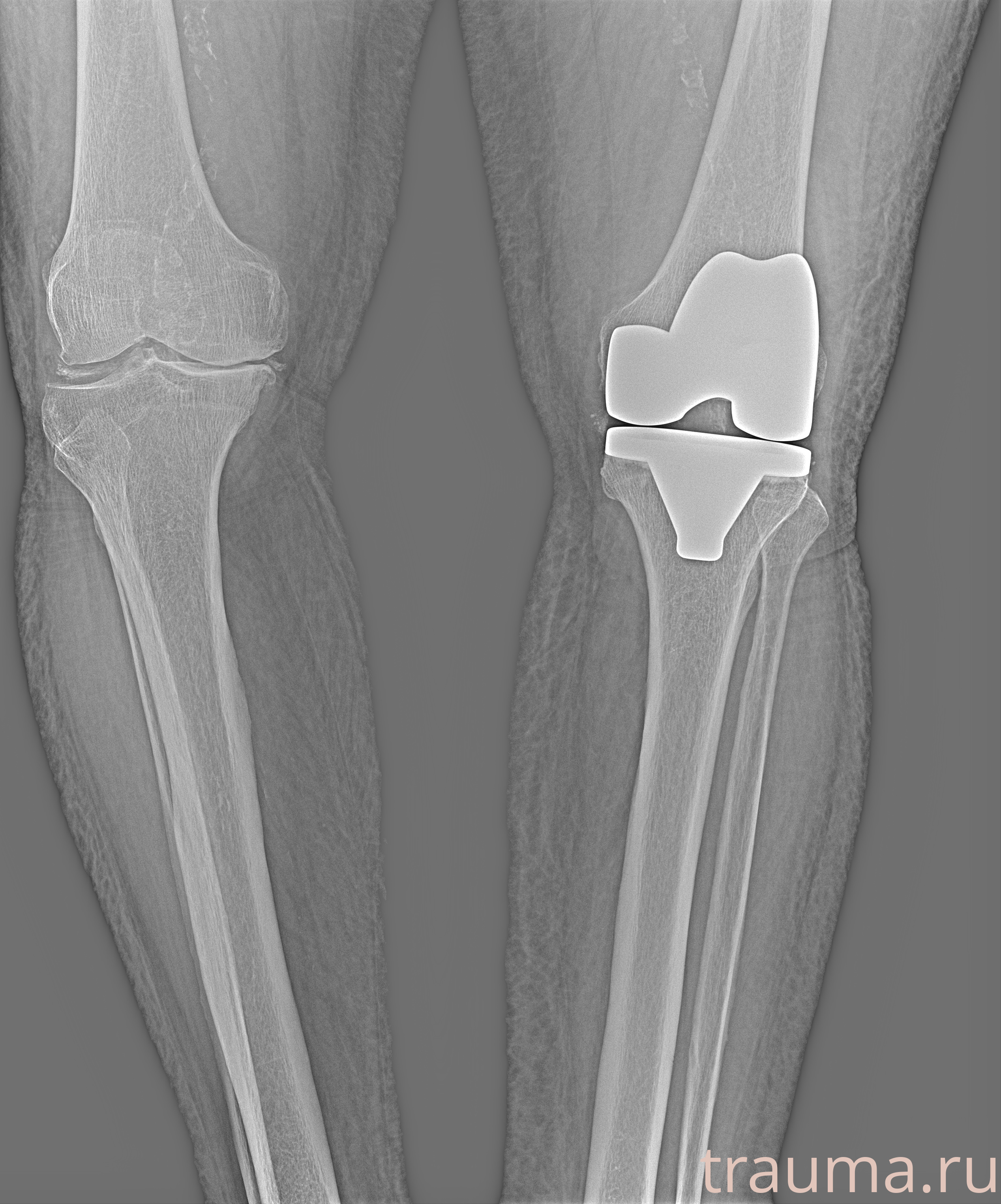Рентген на дому: по вашему адресу приезжает врач-рентгенолог, травматолог-ортопед с мобильным рентгеновским аппаратом, проводит диагностику травмы или заболевания, делает необходимые рентгенограммы, дает рекомендации по дальнейшему лечению. Получить качественные снимки в домашних условиях возможно благодаря уникальной методике, разработанной МосРентген Центром для института  Склифосовского