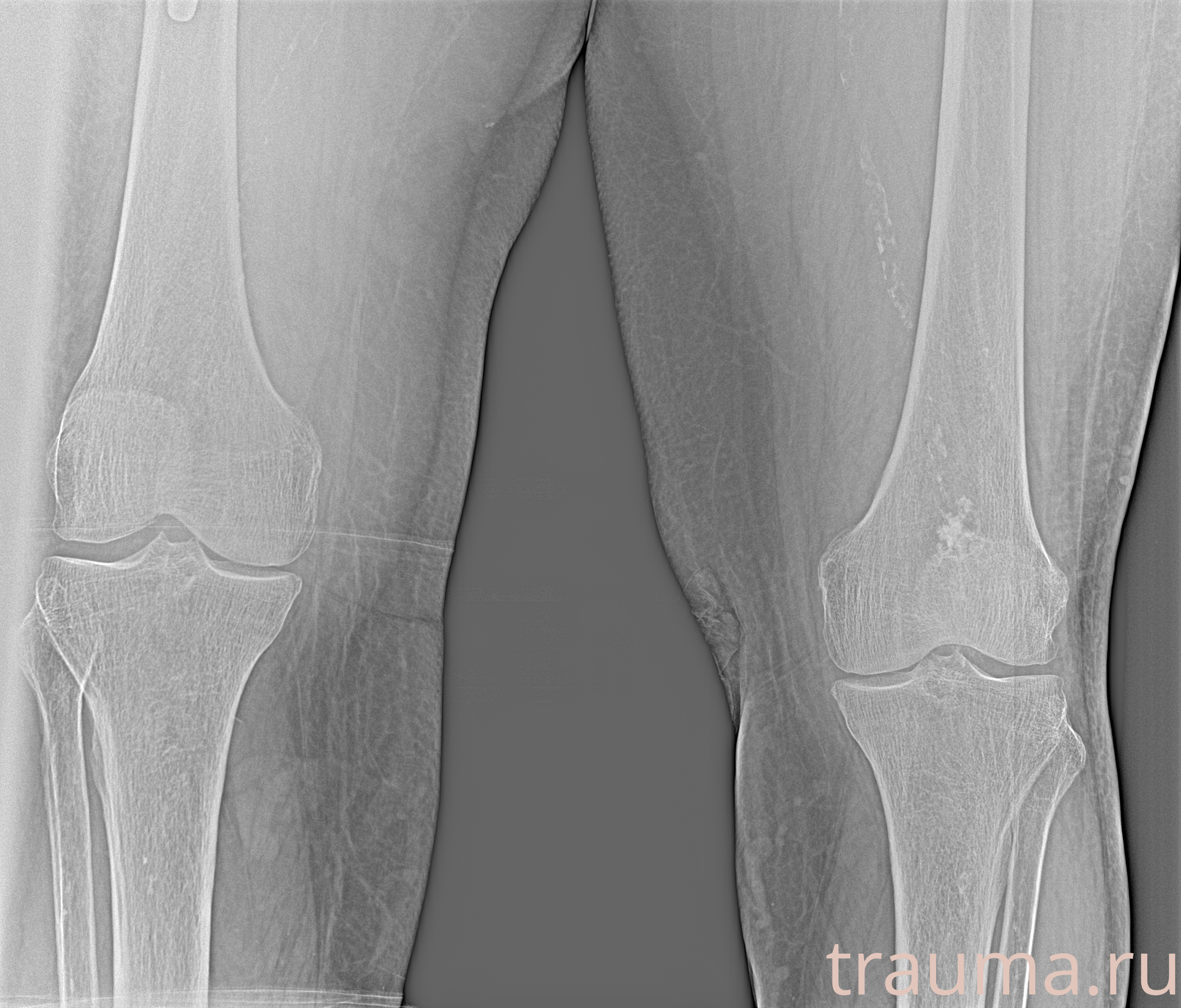 Рентген на дому: по вашему адресу приезжает врач-рентгенолог, травматолог-ортопед с мобильным рентгеновским аппаратом, проводит диагностику травмы или заболевания, делает необходимые рентгенограммы, дает рекомендации по дальнейшему лечению. Получить качественные снимки в домашних условиях возможно благодаря уникальной методике, разработанной МосРентген Центром для института  Склифосовского