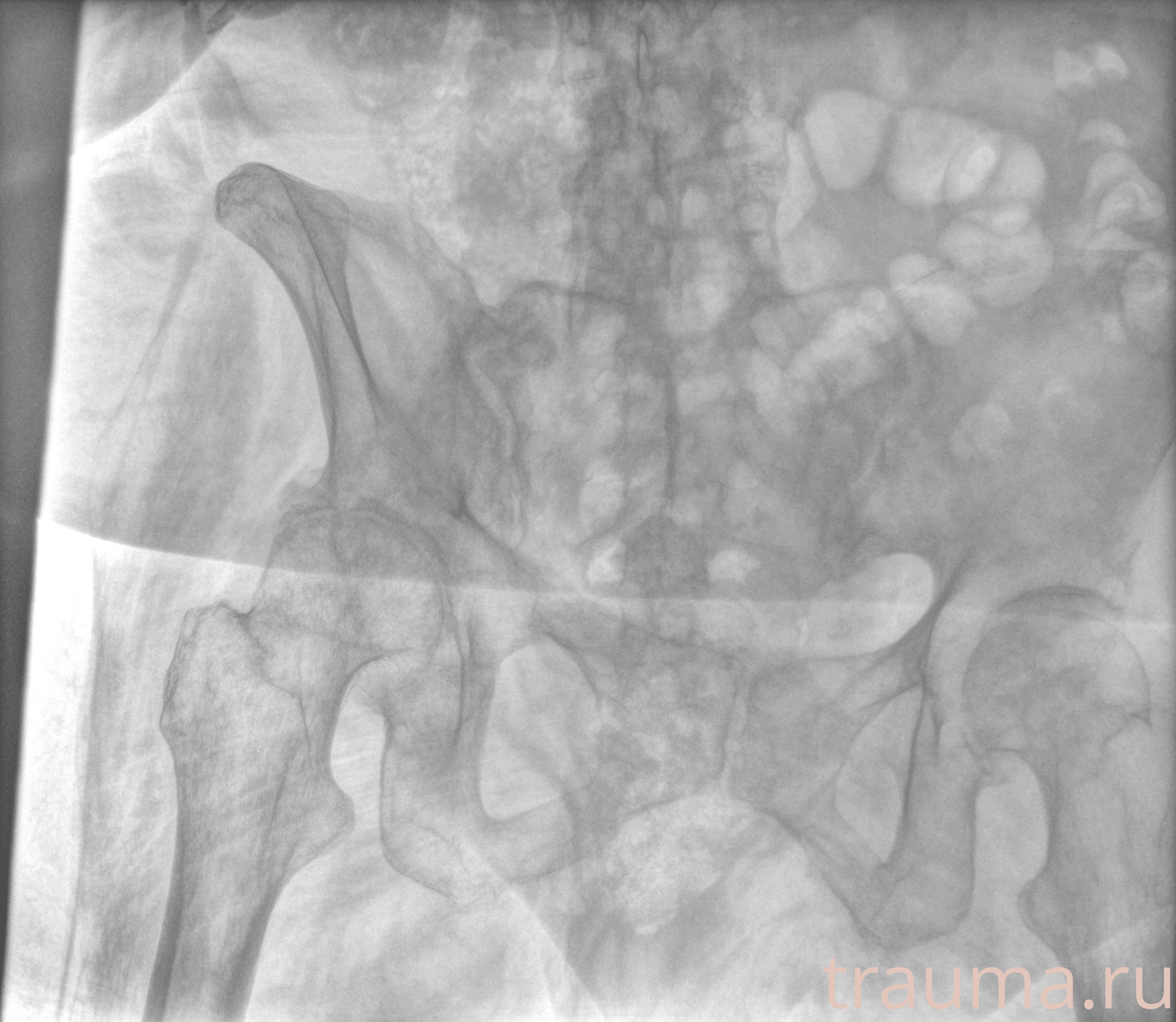 Рентген на дому: по вашему адресу приезжает врач-рентгенолог, травматолог-ортопед с мобильным рентгеновским аппаратом, проводит диагностику травмы или заболевания, делает необходимые рентгенограммы, дает рекомендации по дальнейшему лечению. Получить качественные снимки в домашних условиях возможно благодаря уникальной методике, разработанной МосРентген Центром для института  Склифосовского