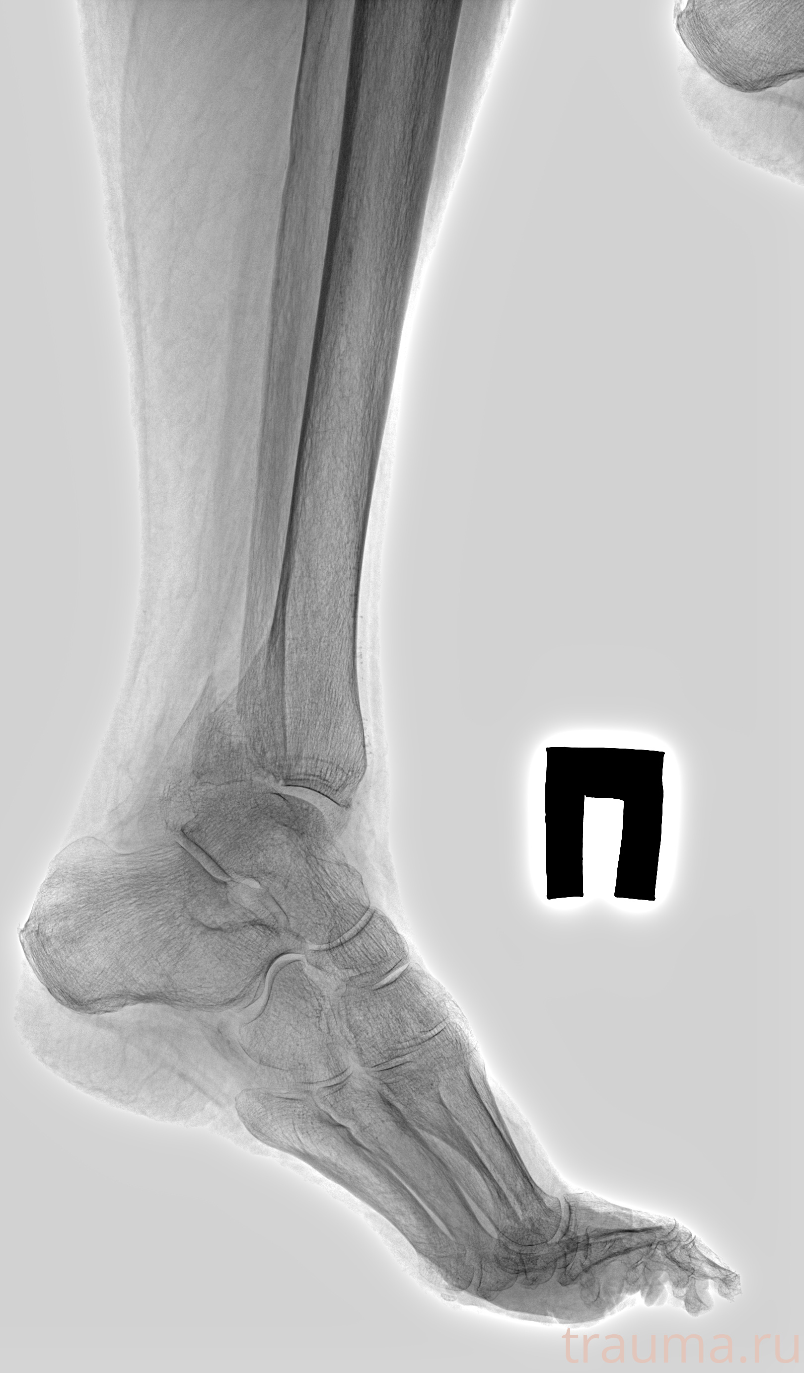 Рентген на дому: по вашему адресу приезжает врач-рентгенолог, травматолог-ортопед с мобильным рентгеновским аппаратом, проводит диагностику травмы или заболевания, делает необходимые рентгенограммы, дает рекомендации по дальнейшему лечению. Получить качественные снимки в домашних условиях возможно благодаря уникальной методике, разработанной МосРентген Центром для института  Склифосовского